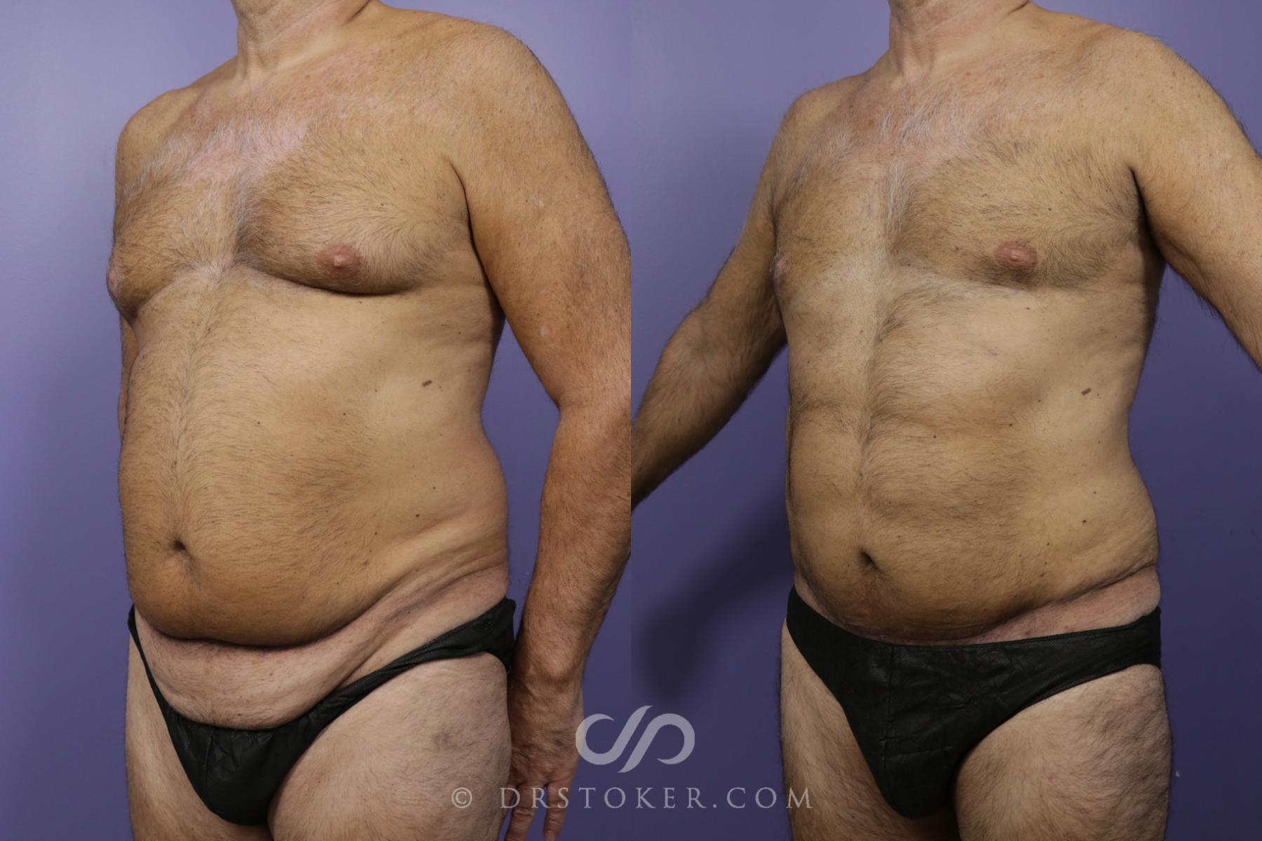 Before & After Abdominal Etching & Sculpting for Men Case 1345 View #1 View in Los Angeles, CA