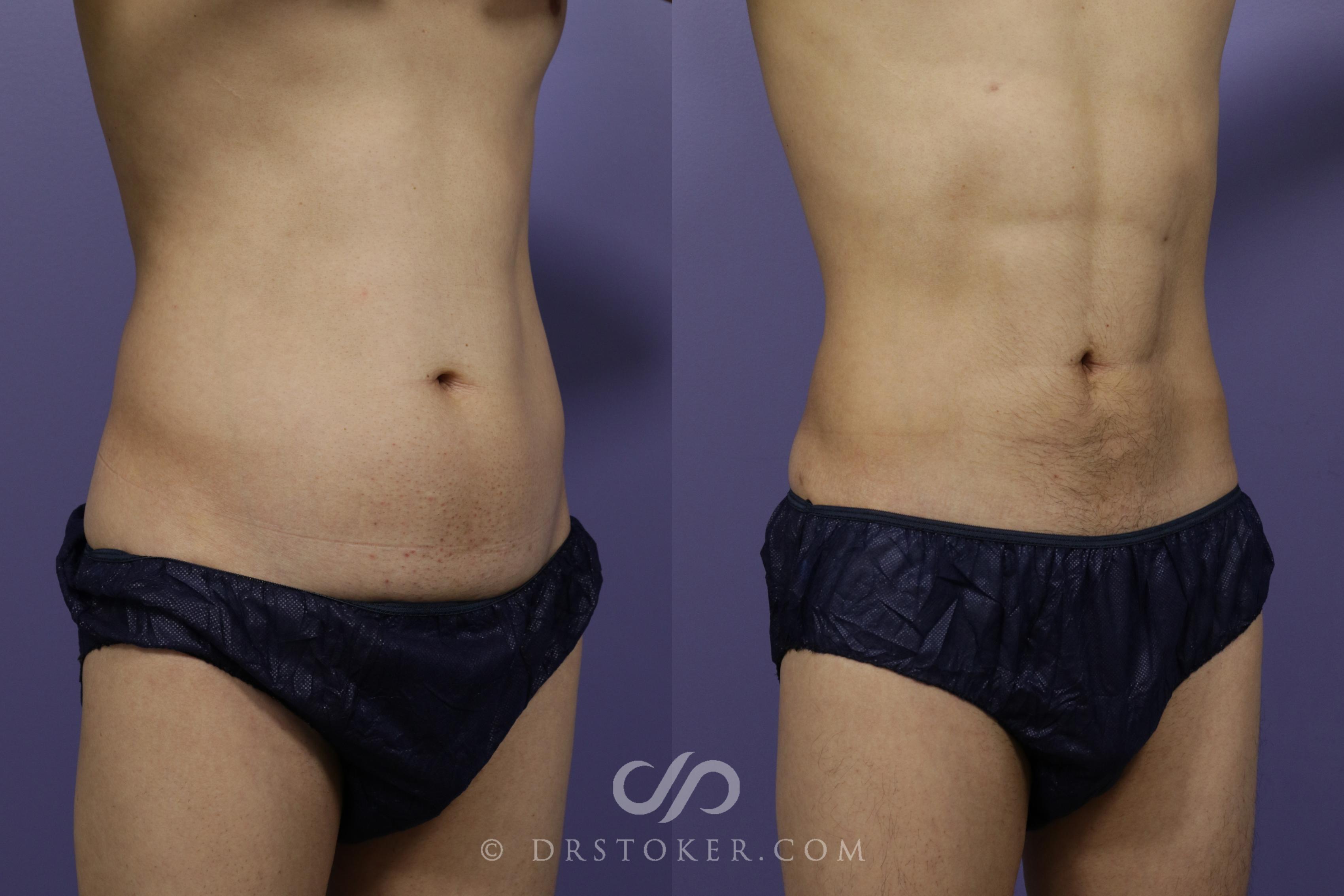 Before & After Liposuction - Abdominal Etching & Sculpting Case 1346 View #1 View in Los Angeles, CA
