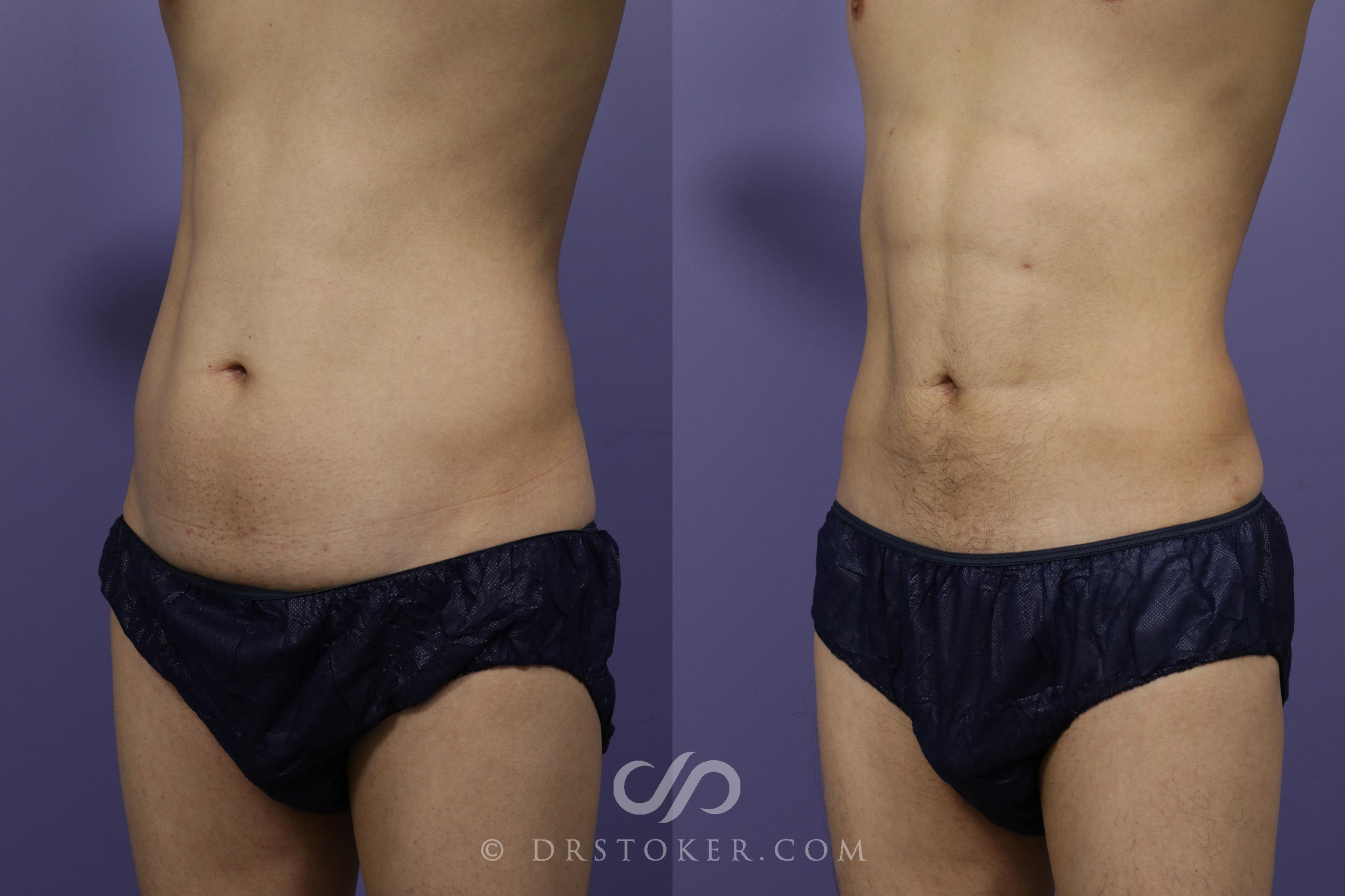 Before & After Liposuction - Abdominal Etching & Sculpting Case 1346 View #2 View in Los Angeles, CA