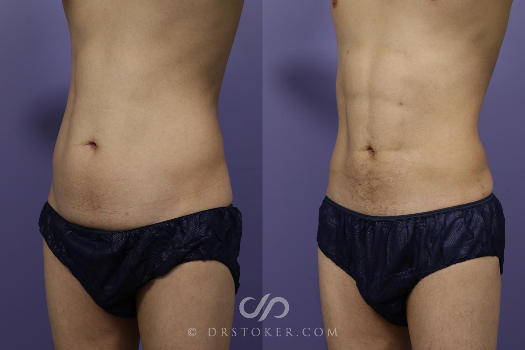 Before & After Abdominal Etching & Sculpting for Men Case 1346 View #2 View in Los Angeles, CA