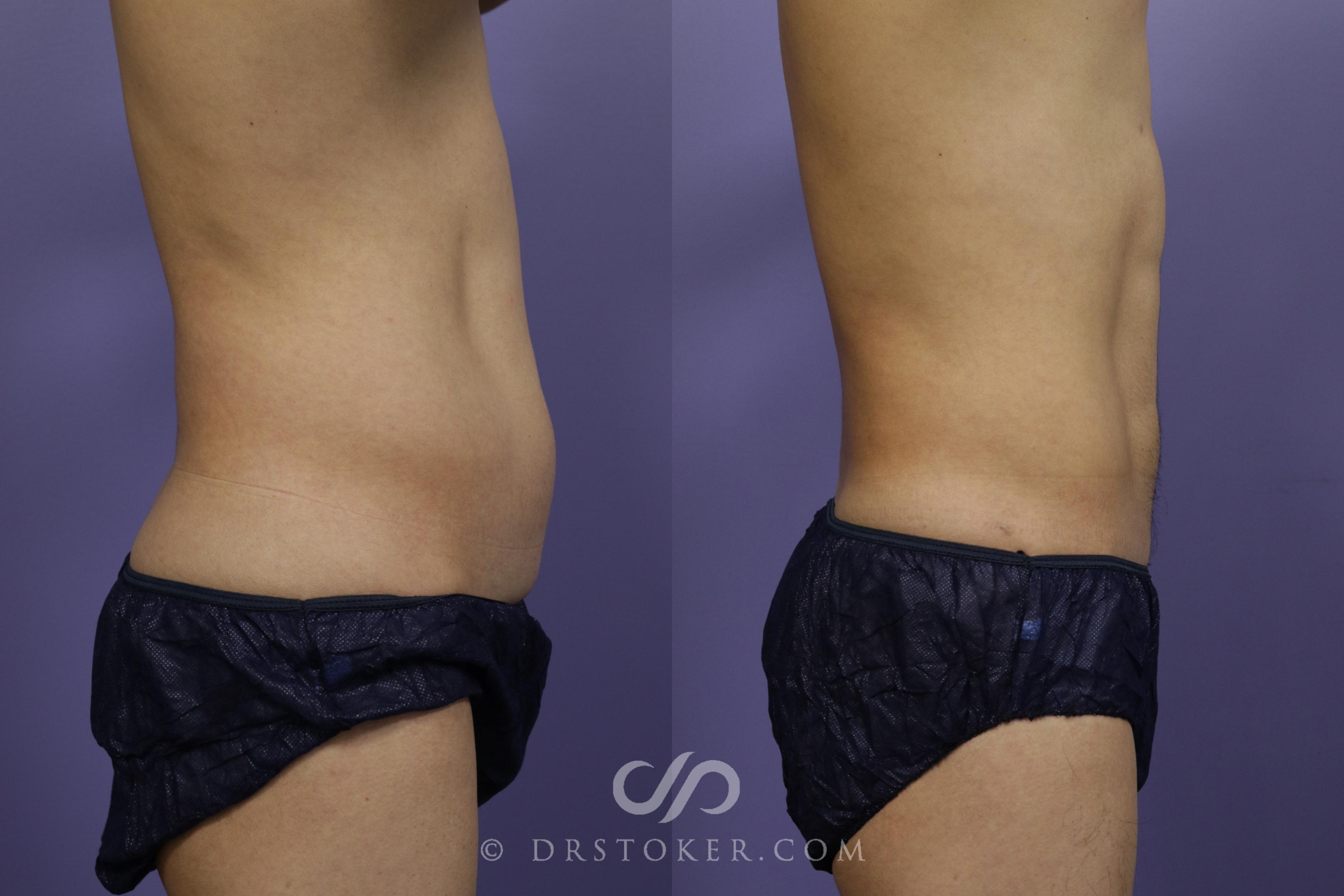 Before & After Liposuction - Abdominal Etching & Sculpting Case 1347 View #1 View in Los Angeles, CA