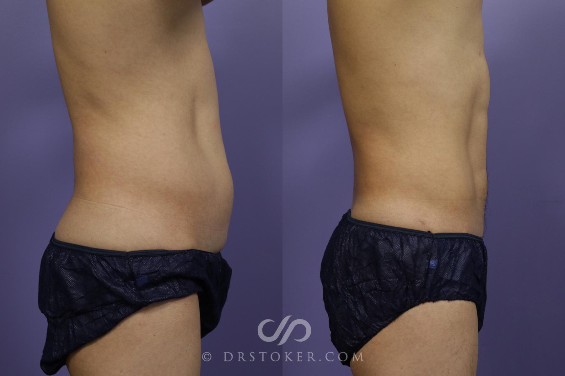 Before & After Abdominal Etching & Sculpting for Men Case 1347 View #1 View in Los Angeles, CA