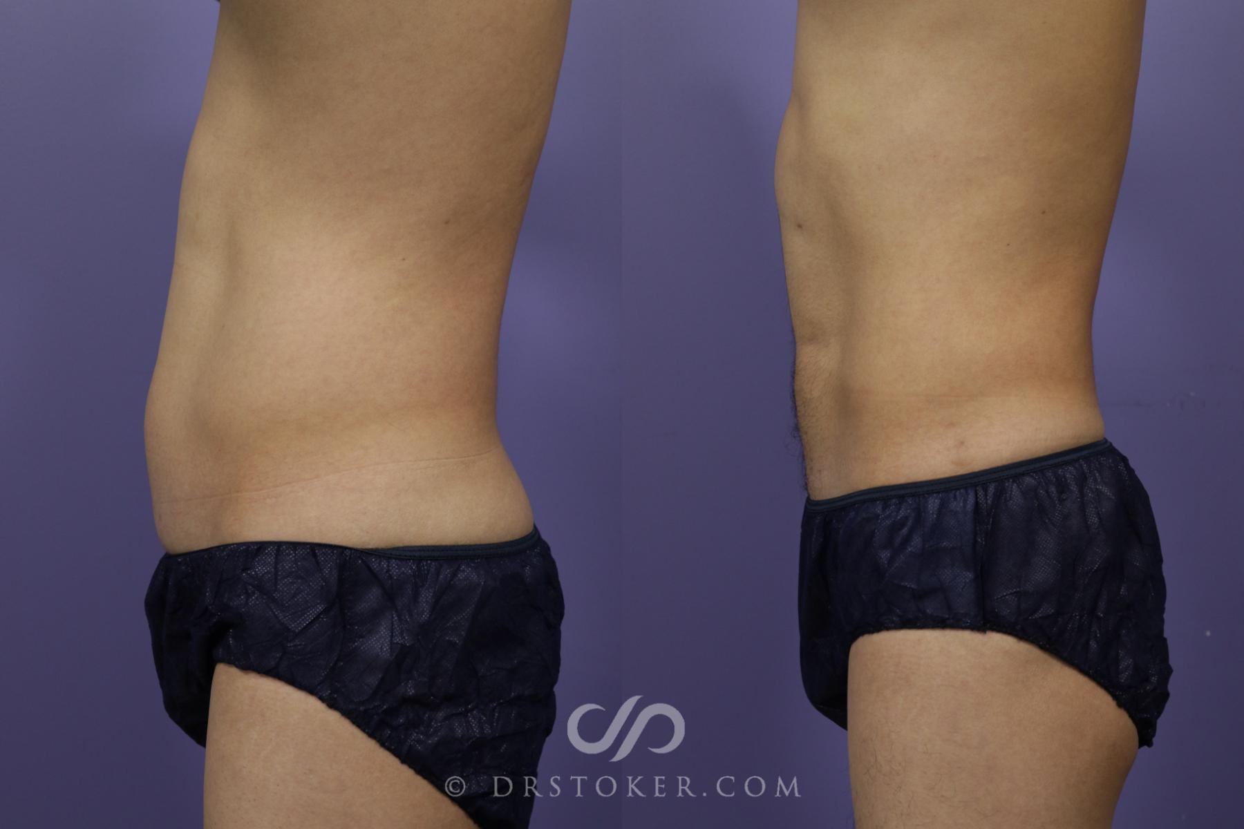 Before & After Abdominal Etching & Sculpting for Men Case 1347 View #2 View in Los Angeles, CA