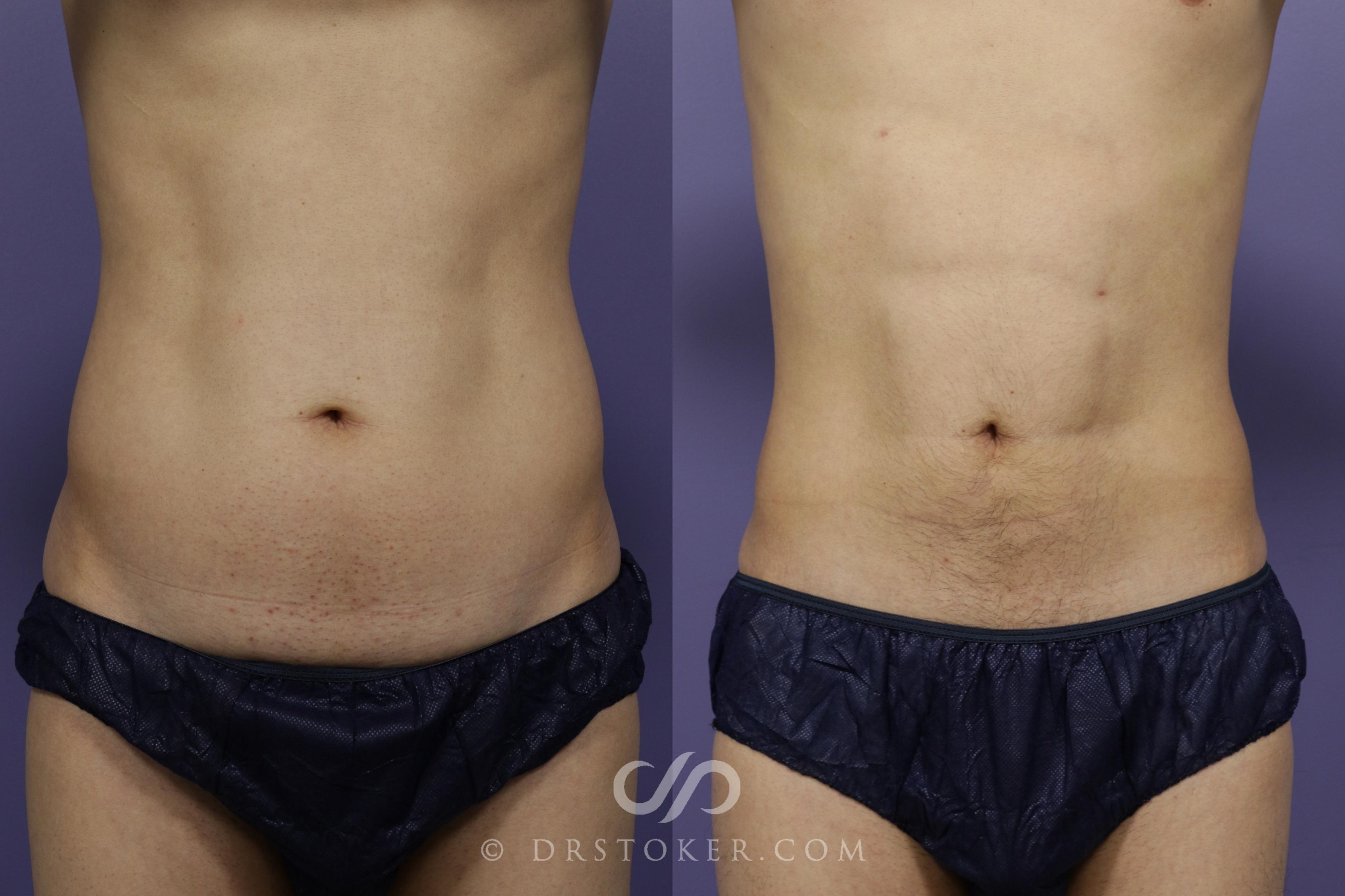 Before & After Liposuction - Abdominal Etching & Sculpting Case 1348 View #1 View in Los Angeles, CA