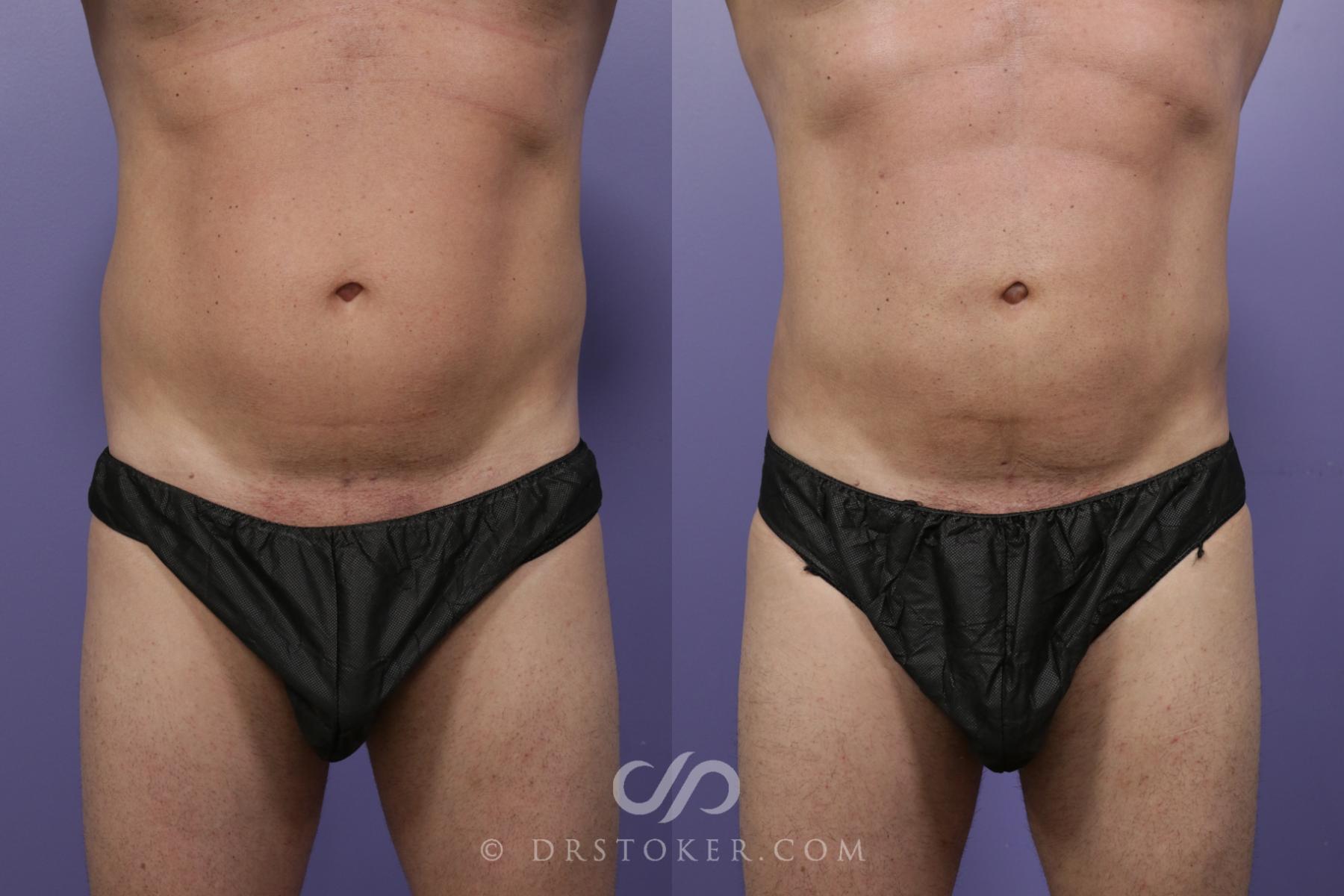 Before & After Liposuction - Abdominal Etching & Sculpting Case 1537 View #1 View in Los Angeles, CA