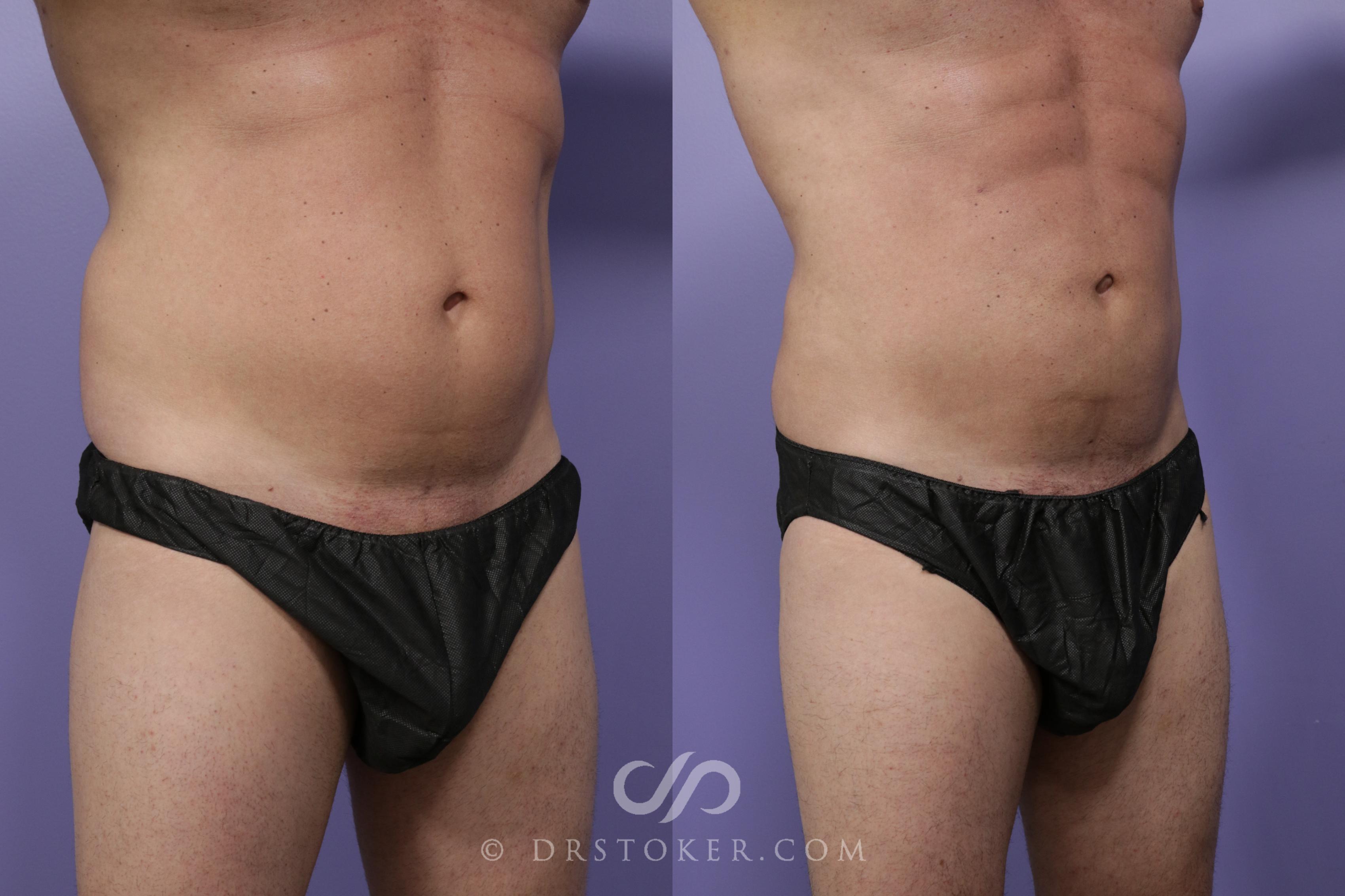 Before & After Liposuction - Abdominal Etching & Sculpting Case 1537 View #2 View in Los Angeles, CA