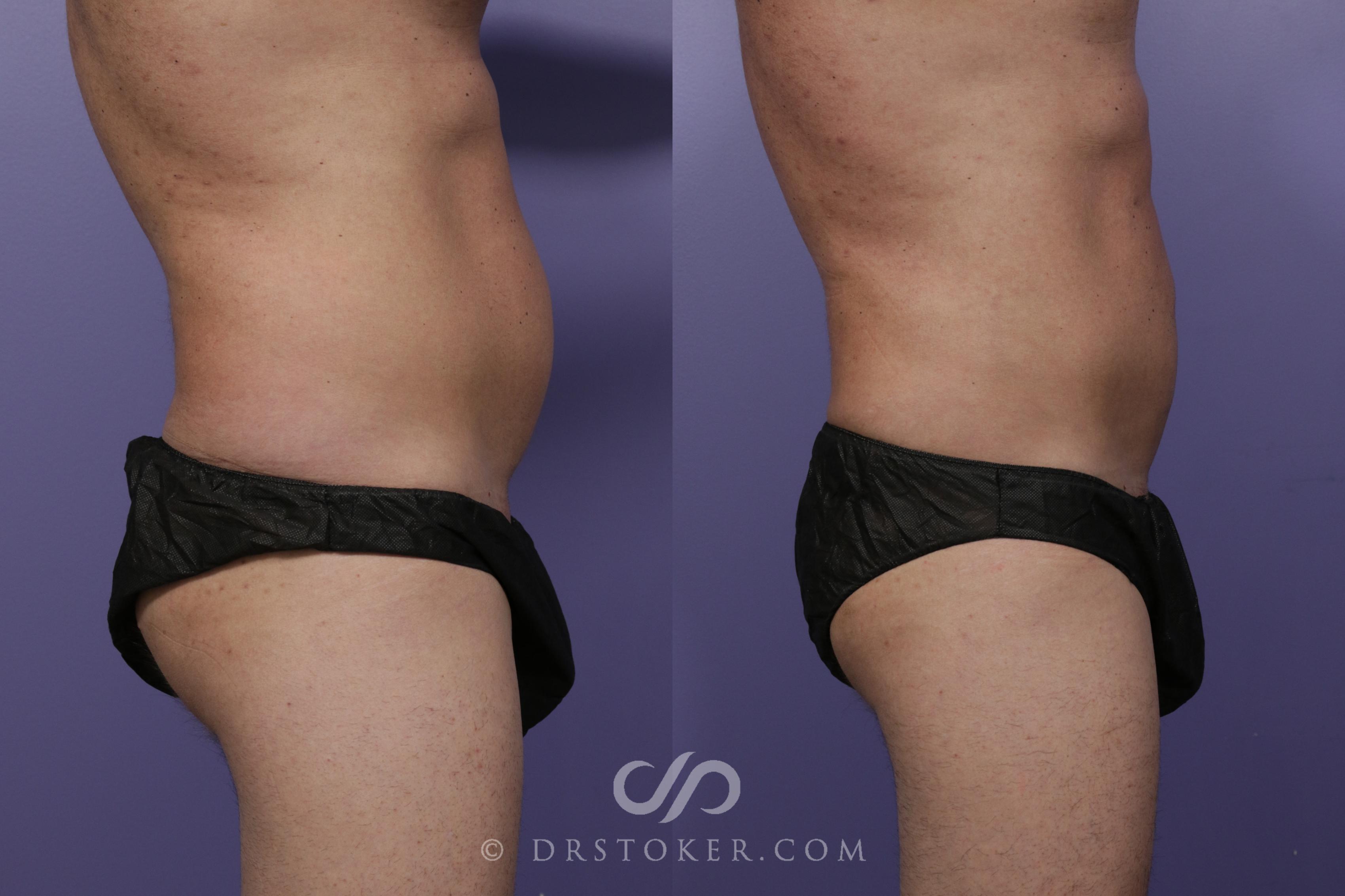Before & After Liposuction - Abdominal Etching & Sculpting Case 1537 View #3 View in Los Angeles, CA