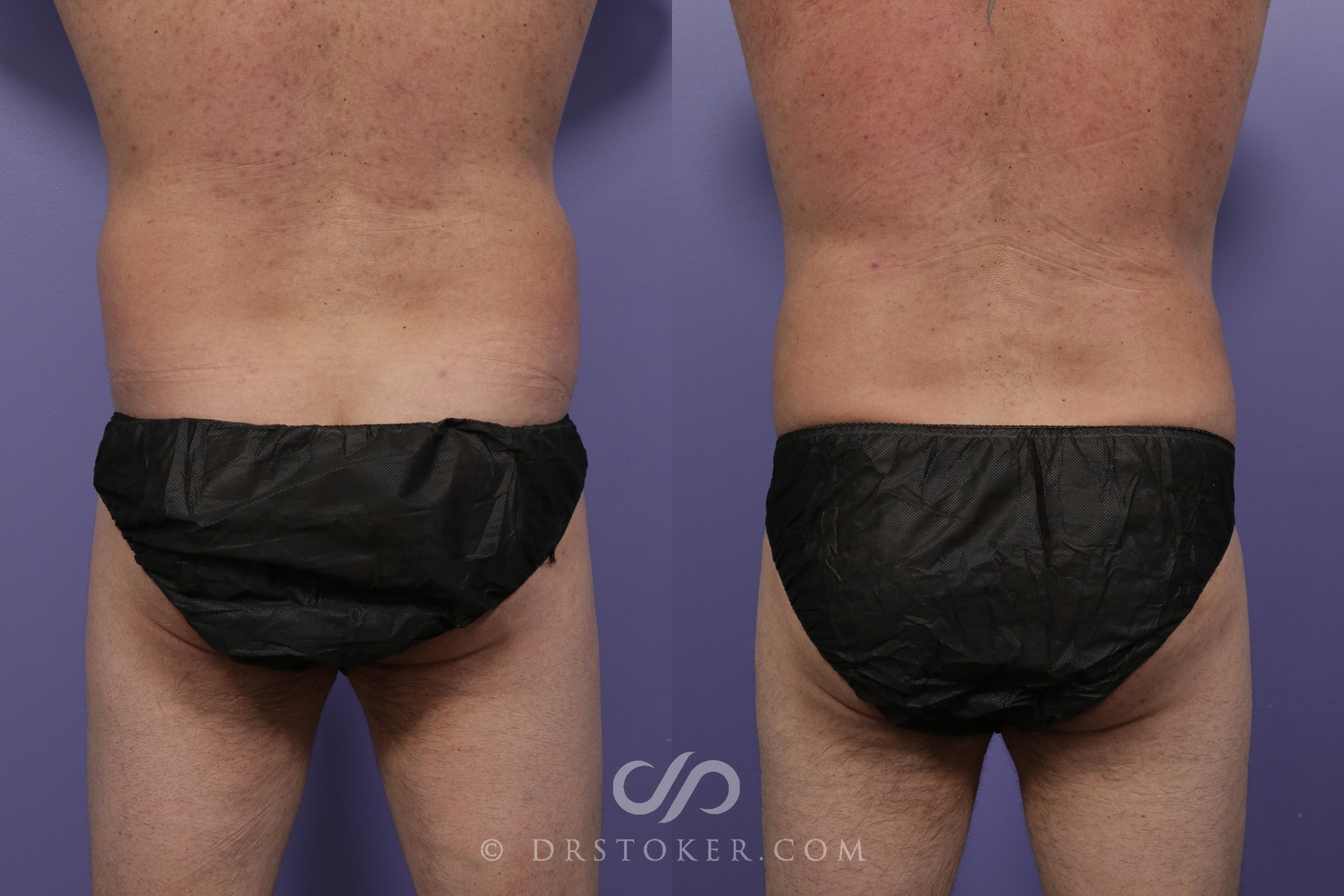 Before & After Liposuction - Abdominal Etching & Sculpting Case 1539 View #1 View in Los Angeles, CA