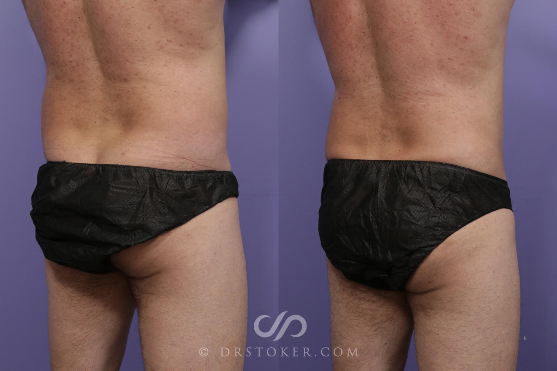 Before & After Liposuction - Abdominal Etching & Sculpting Case 1539 View #2 View in Los Angeles, CA