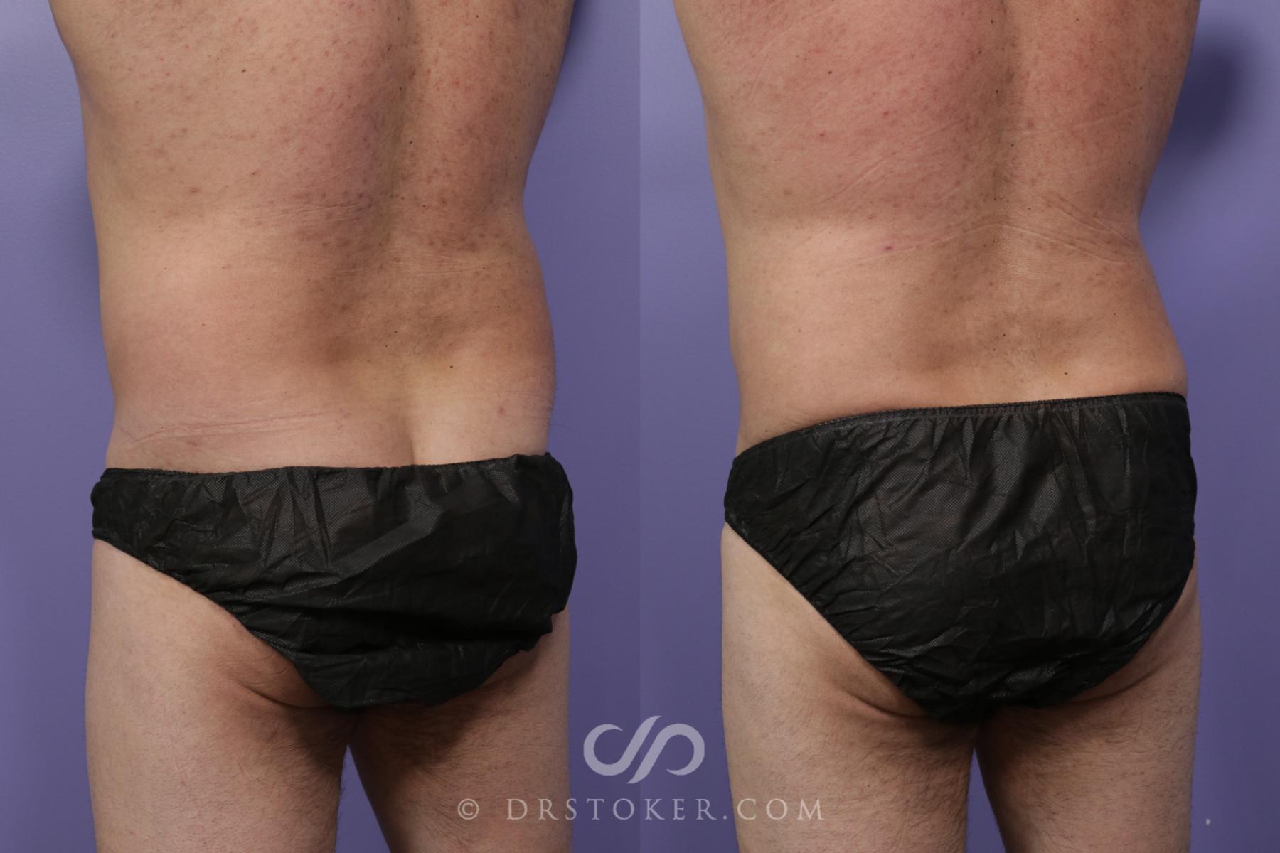 Before & After Liposuction Case 1539 View #3 View in Los Angeles, CA