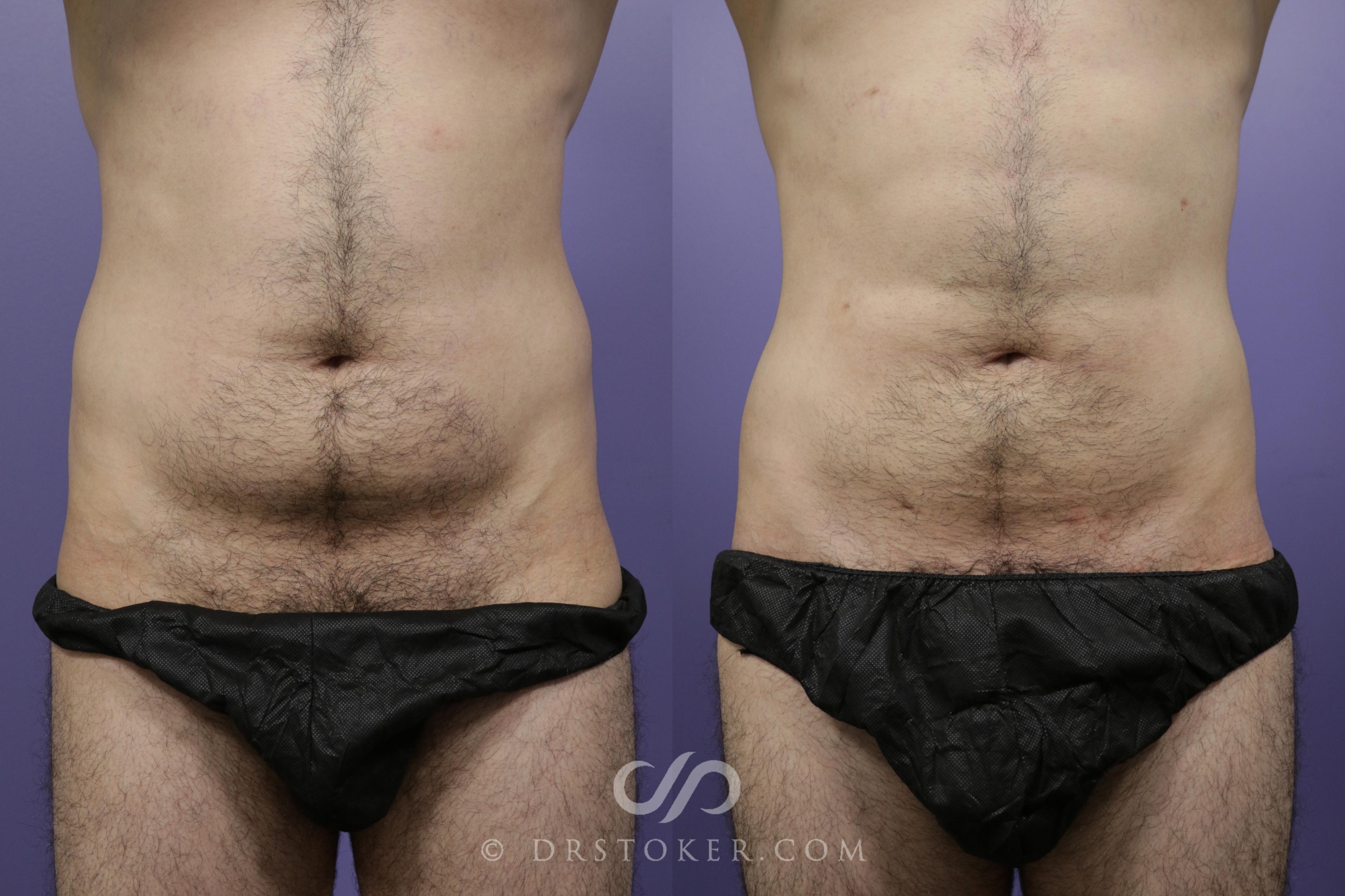 Before & After Abdominal Etching & Sculpting for Men Case 1557 View #1 View in Marina del Rey, CA