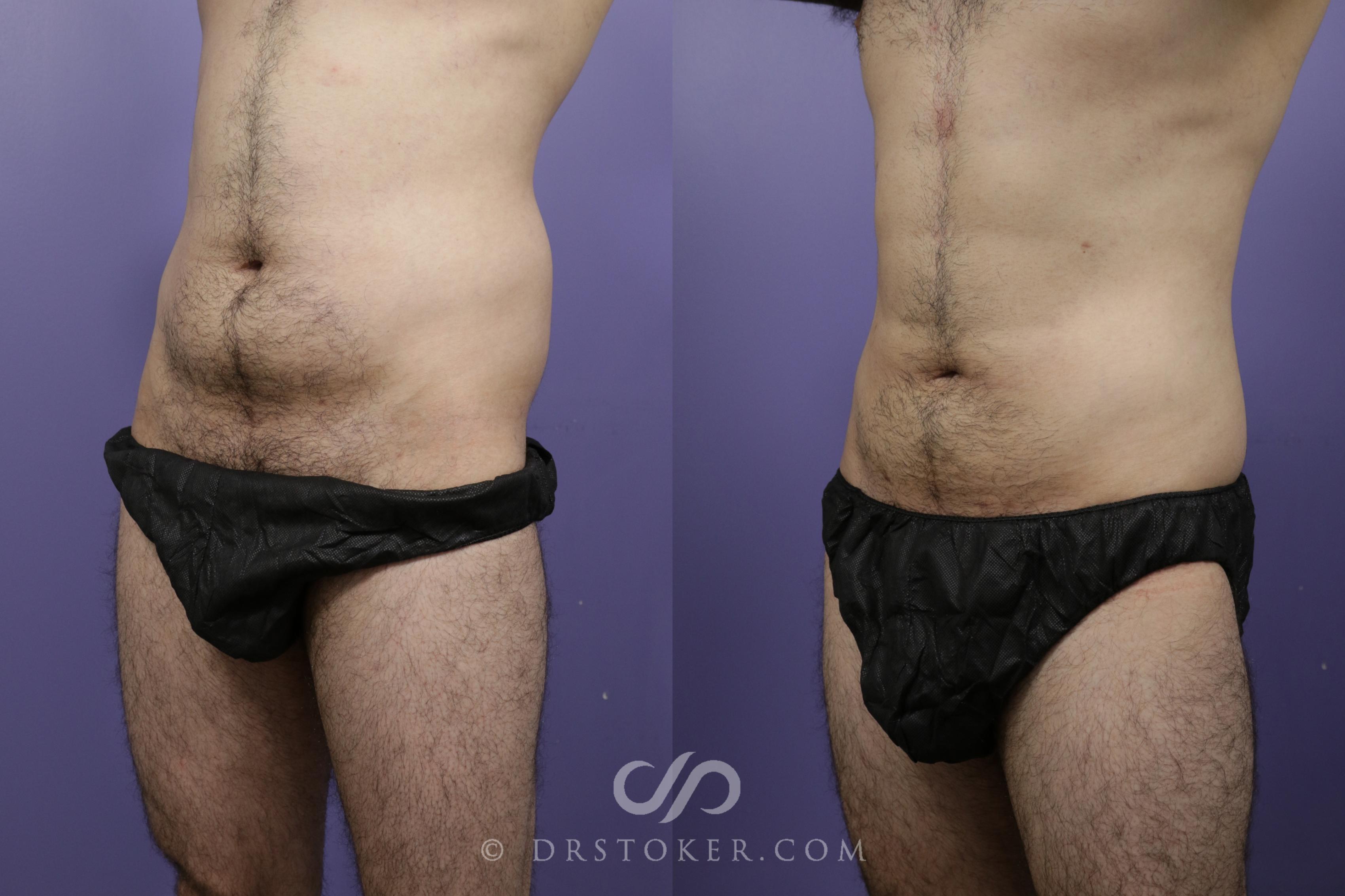 Before & After Liposuction - Abdominal Etching & Sculpting Case 1557 View #2 View in Los Angeles, CA