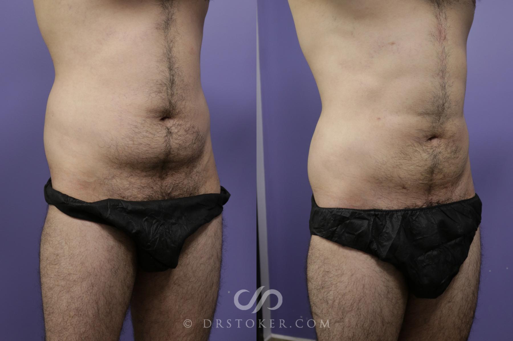 Before & After Liposuction Case 1558 View #1 View in Los Angeles, CA