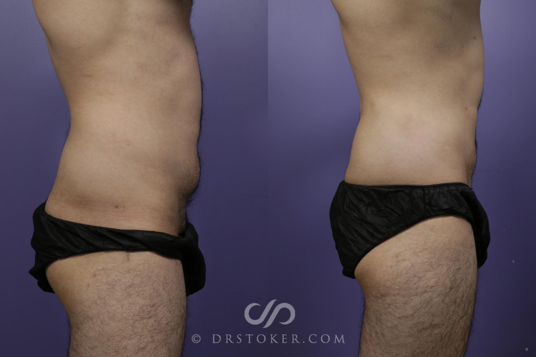 Before & After Liposuction for Men Case 1558 View #2 View in Los Angeles, CA