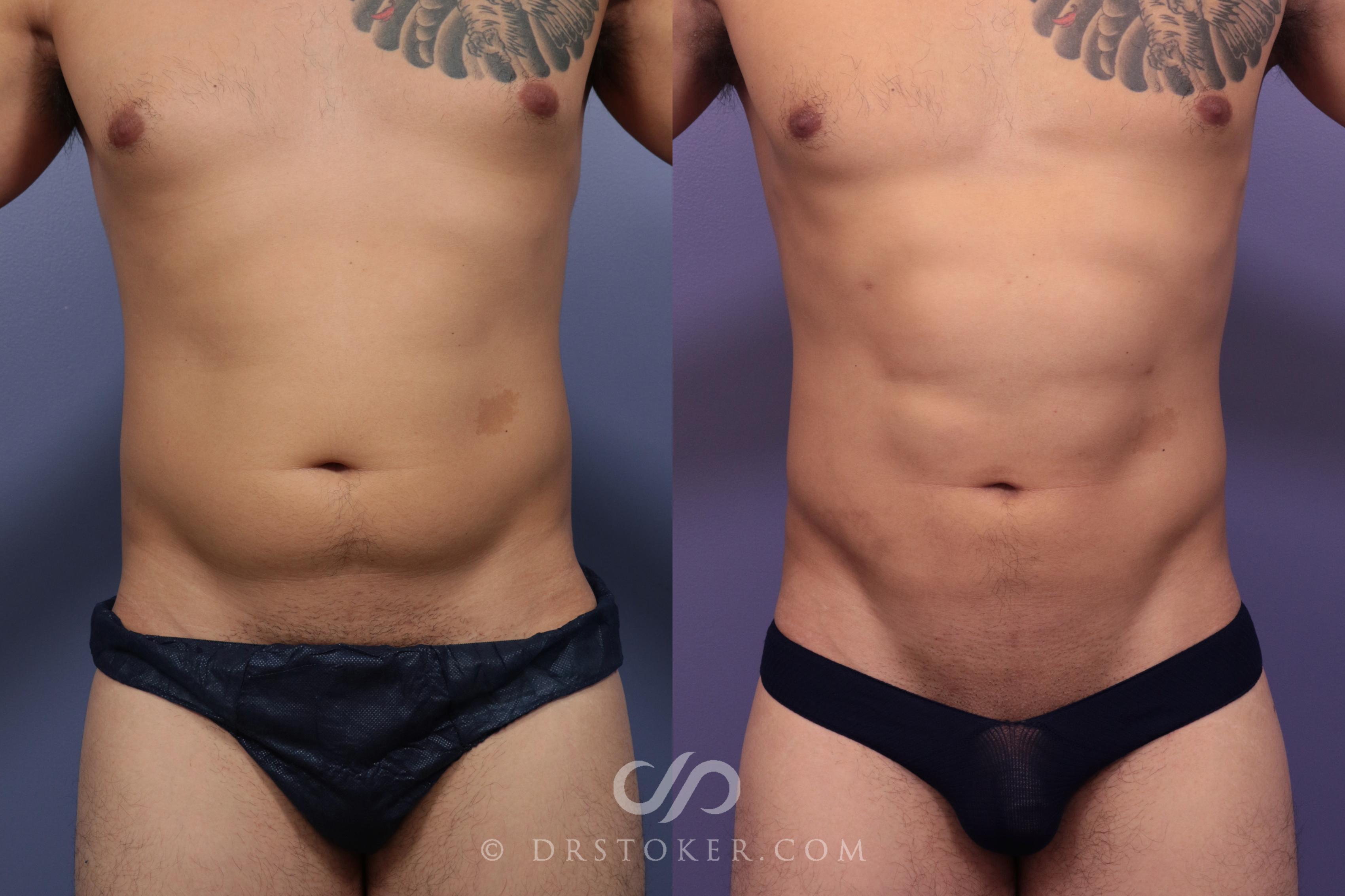 Before & After Liposuction - Abdominal Etching & Sculpting Case 972 View #1 View in Los Angeles, CA