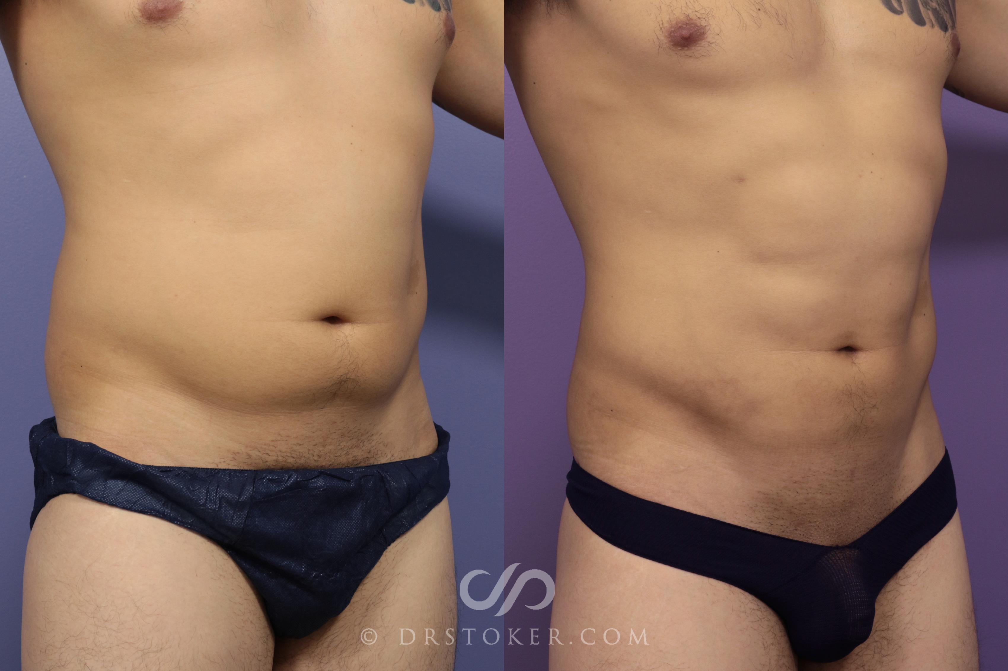 Before & After Liposuction - Abdominal Etching & Sculpting Case 972 View #2 View in Los Angeles, CA