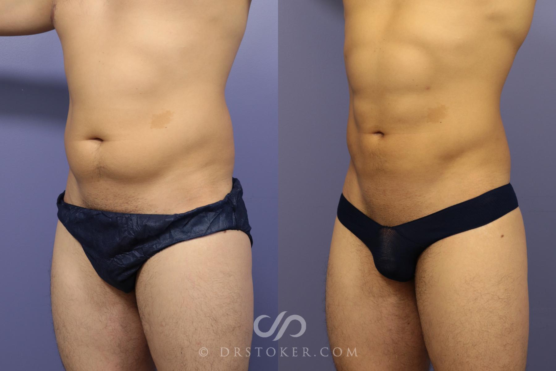 Before & After Abdominal Etching & Sculpting for Men Case 972 View #3 View in Los Angeles, CA