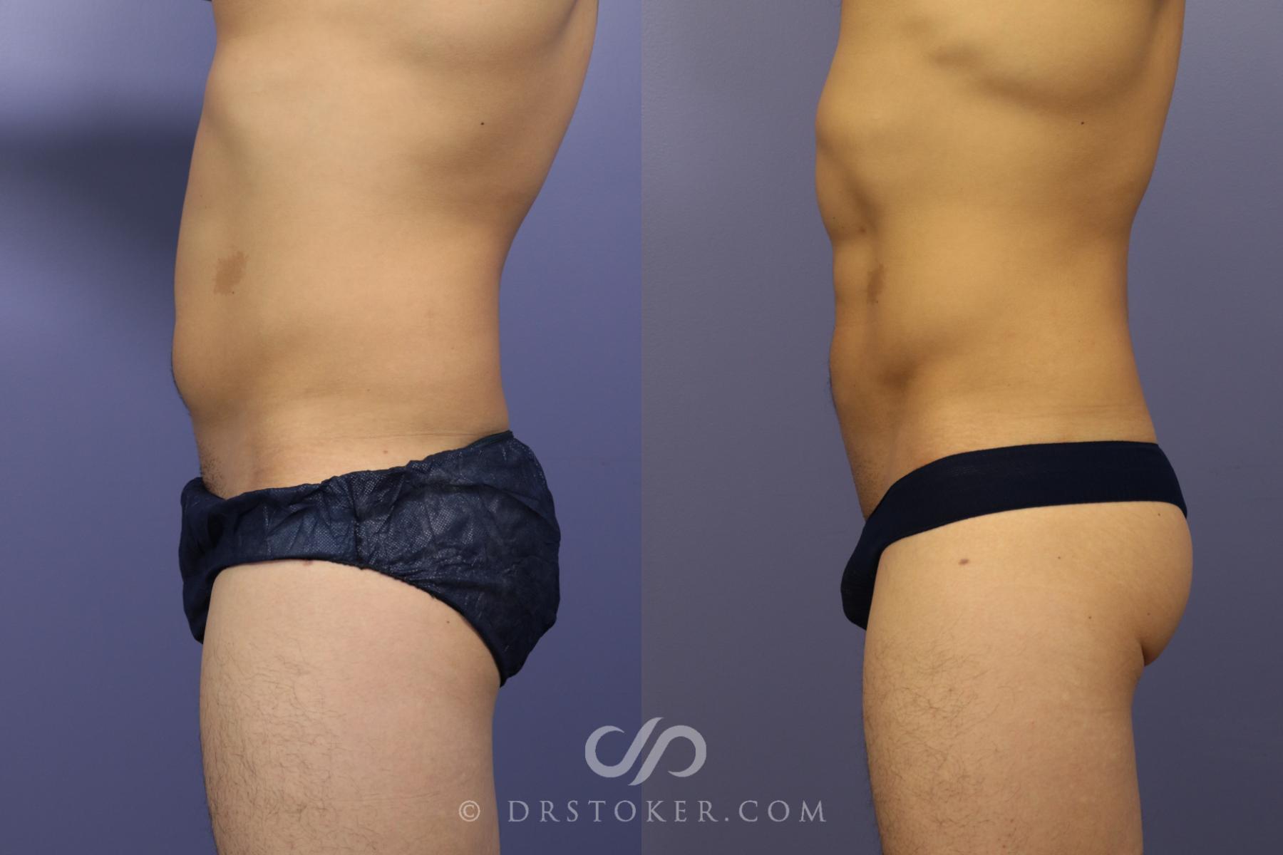 Before & After Liposuction - Abdominal Etching & Sculpting Case 972 View #4 View in Los Angeles, CA