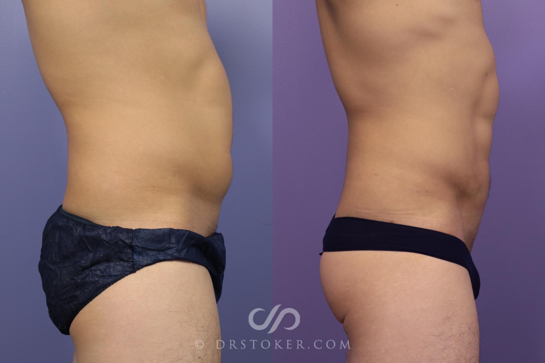 Before & After Abdominal Etching & Sculpting for Men Case 972 View #5 View in Los Angeles, CA