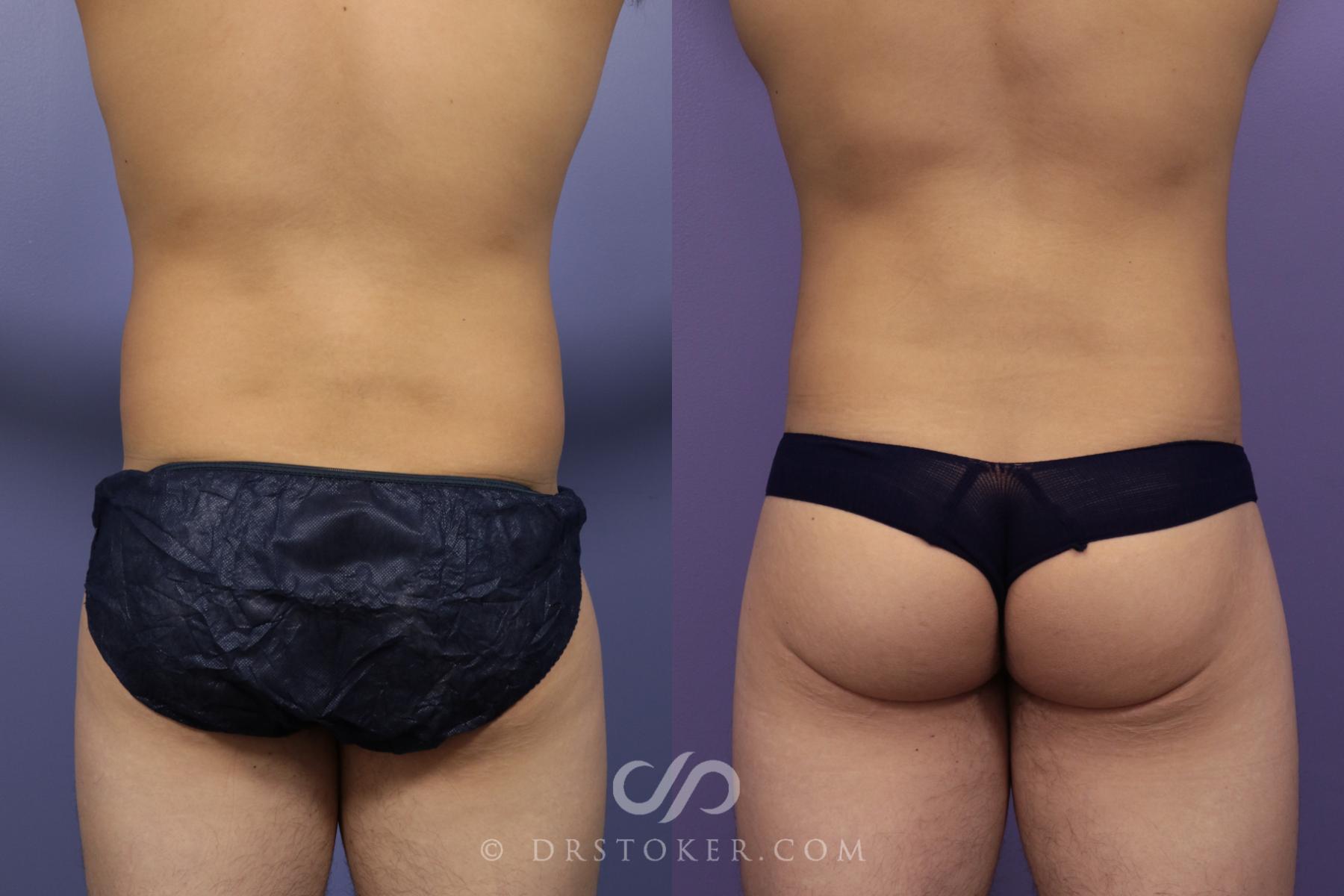 Before & After Liposuction Case 972 View #6 View in Los Angeles, CA