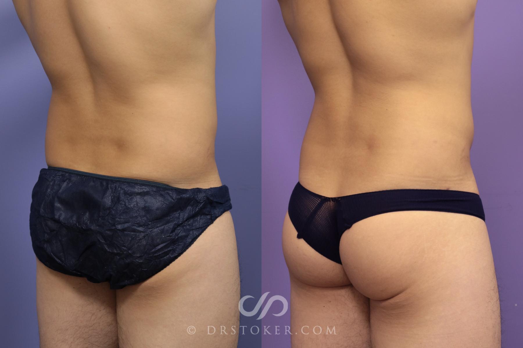 Before & After Abdominal Etching & Sculpting for Men Case 972 View #7 View in Los Angeles, CA