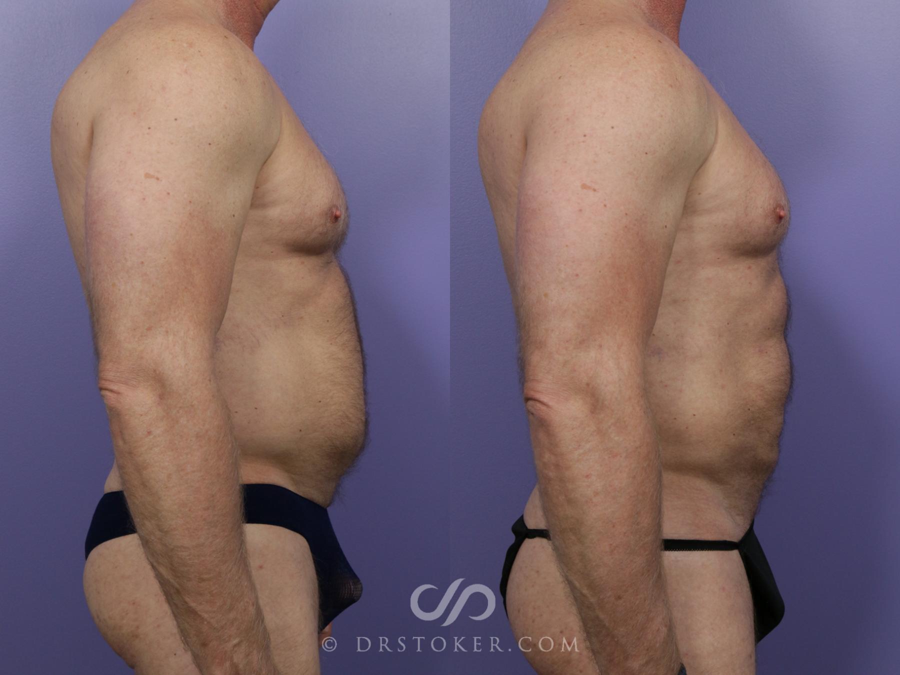 Liposuction - Abdominal Etching & Sculpting Before and After Pictures Case  973, Los Angeles, CA