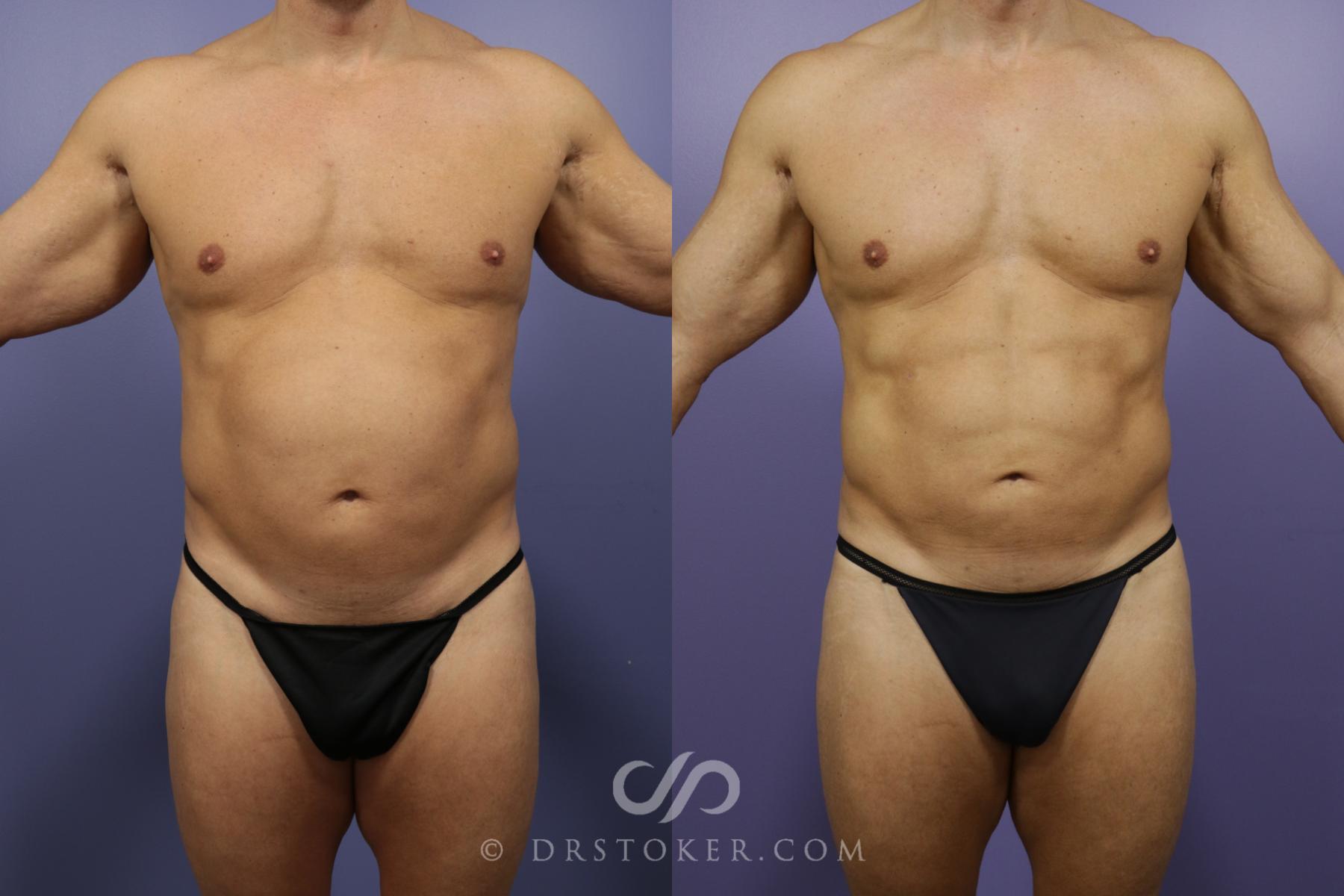 Liposuction - Abdominal Etching & Sculpting Before and After Pictures Case  974, Los Angeles, CA