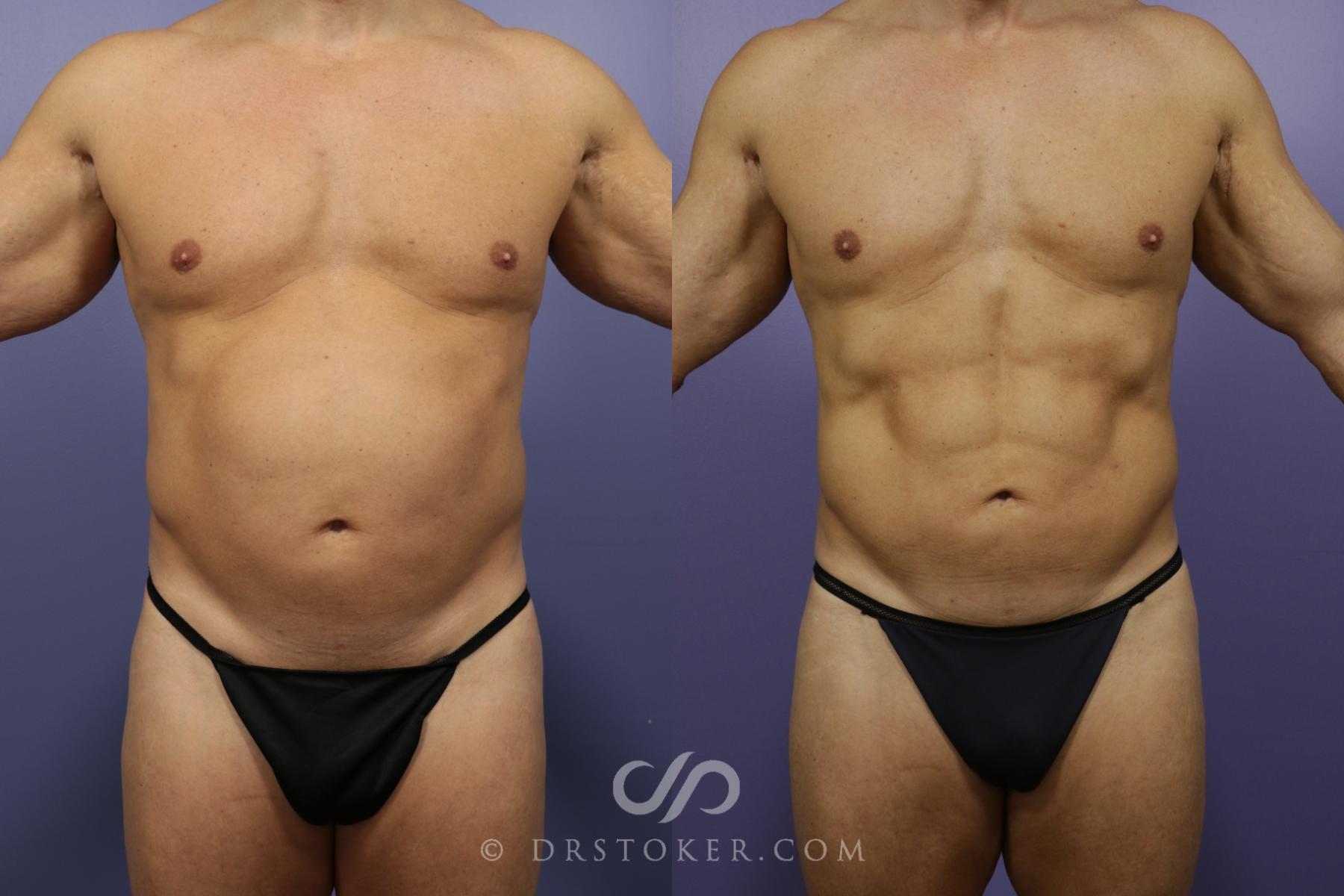 Before & After Abdominal Etching & Sculpting for Men Case 974 View #2 View in Los Angeles, CA