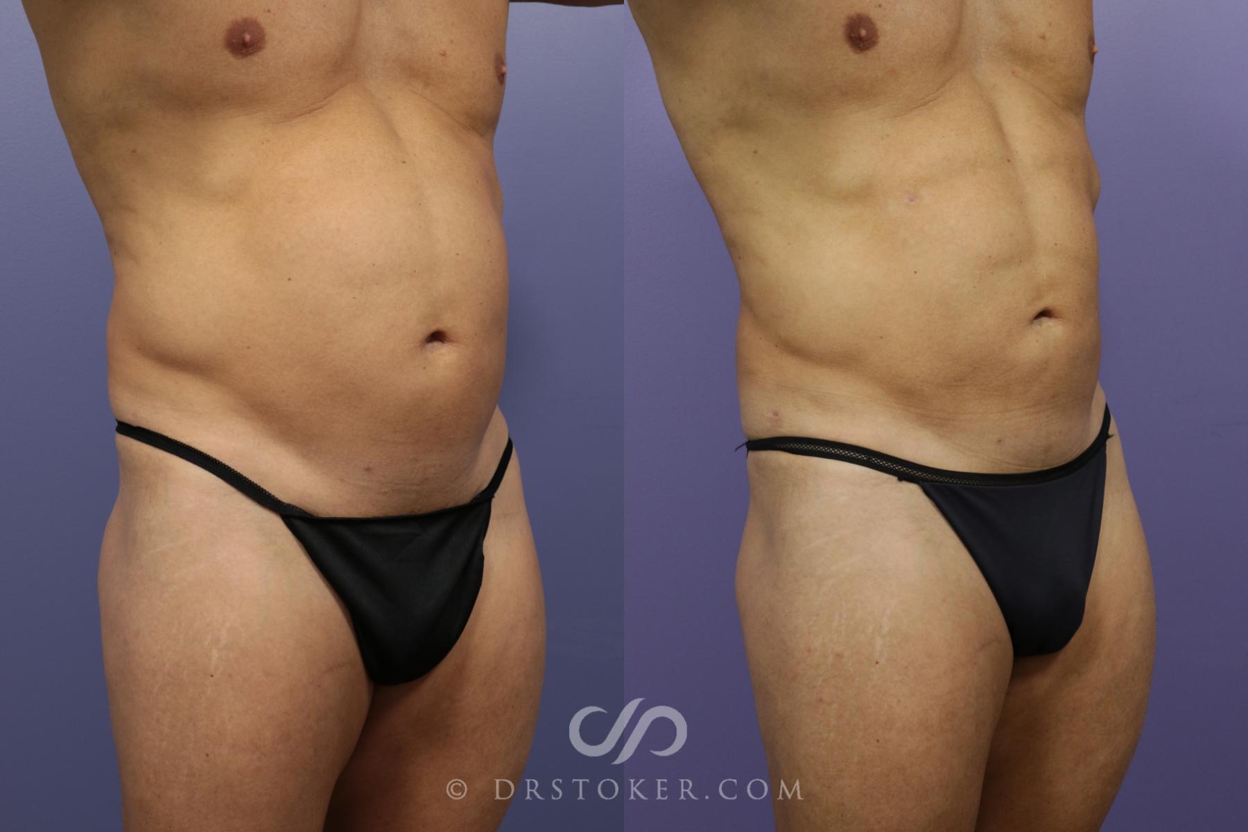 Before & After Liposuction - Abdominal Etching & Sculpting Case 974 View #3 View in Los Angeles, CA