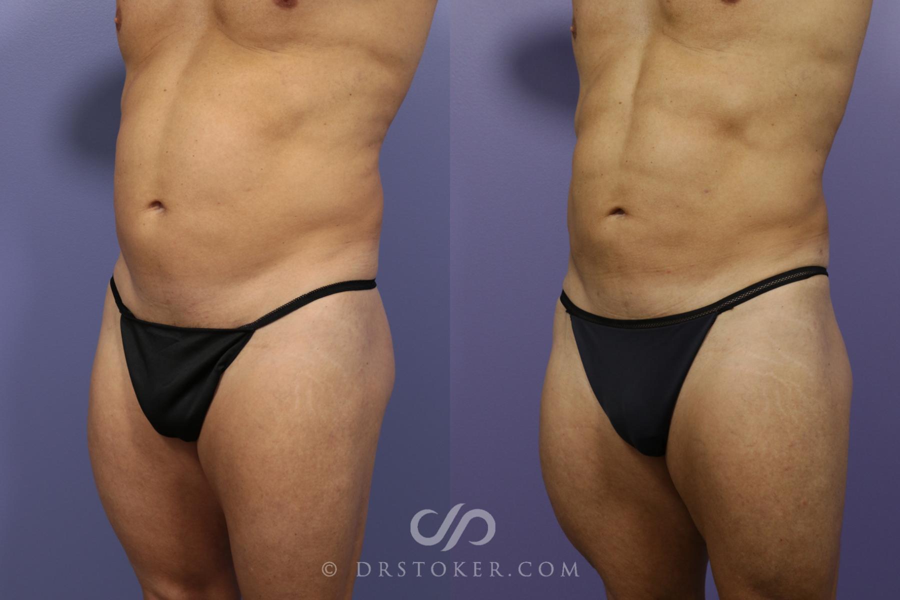 Before & After Liposuction for Men Case 974 View #4 View in Los Angeles, CA