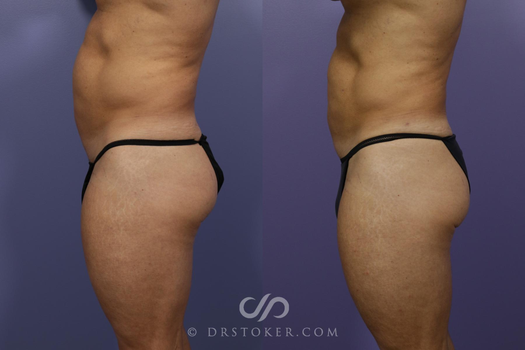 Before & After Liposuction Case 974 View #5 View in Los Angeles, CA
