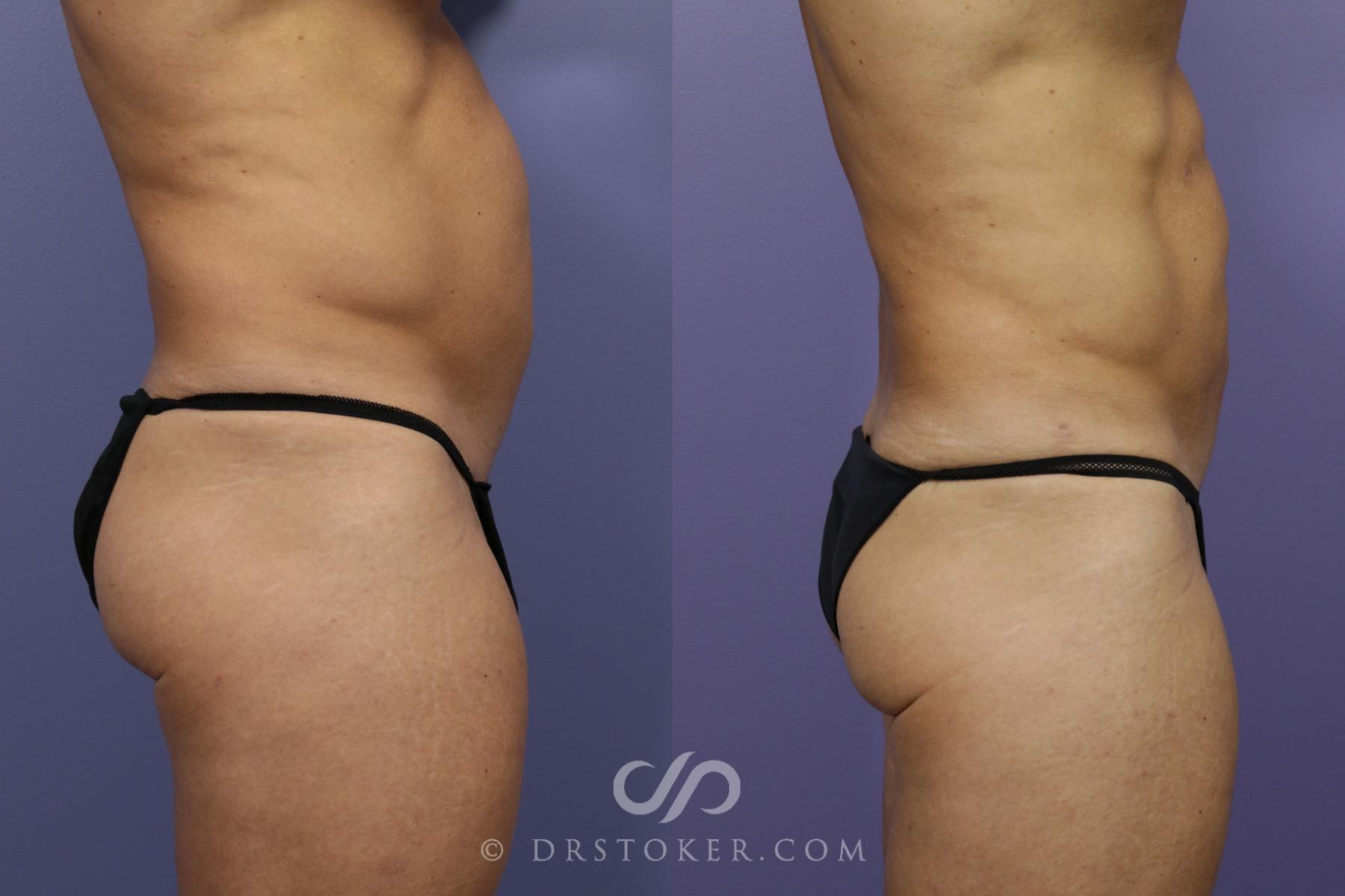 Before & After Liposuction - Abdominal Etching & Sculpting Case 974 View #6 View in Los Angeles, CA