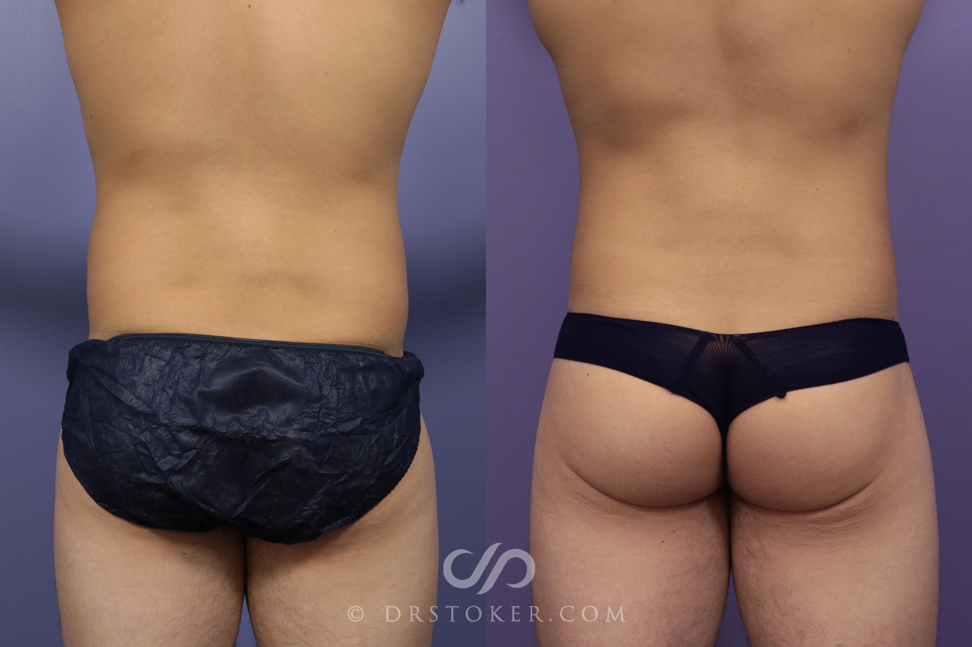 Before & After Liposuction for Men Case 985 View #1 View in Marina del Rey, CA