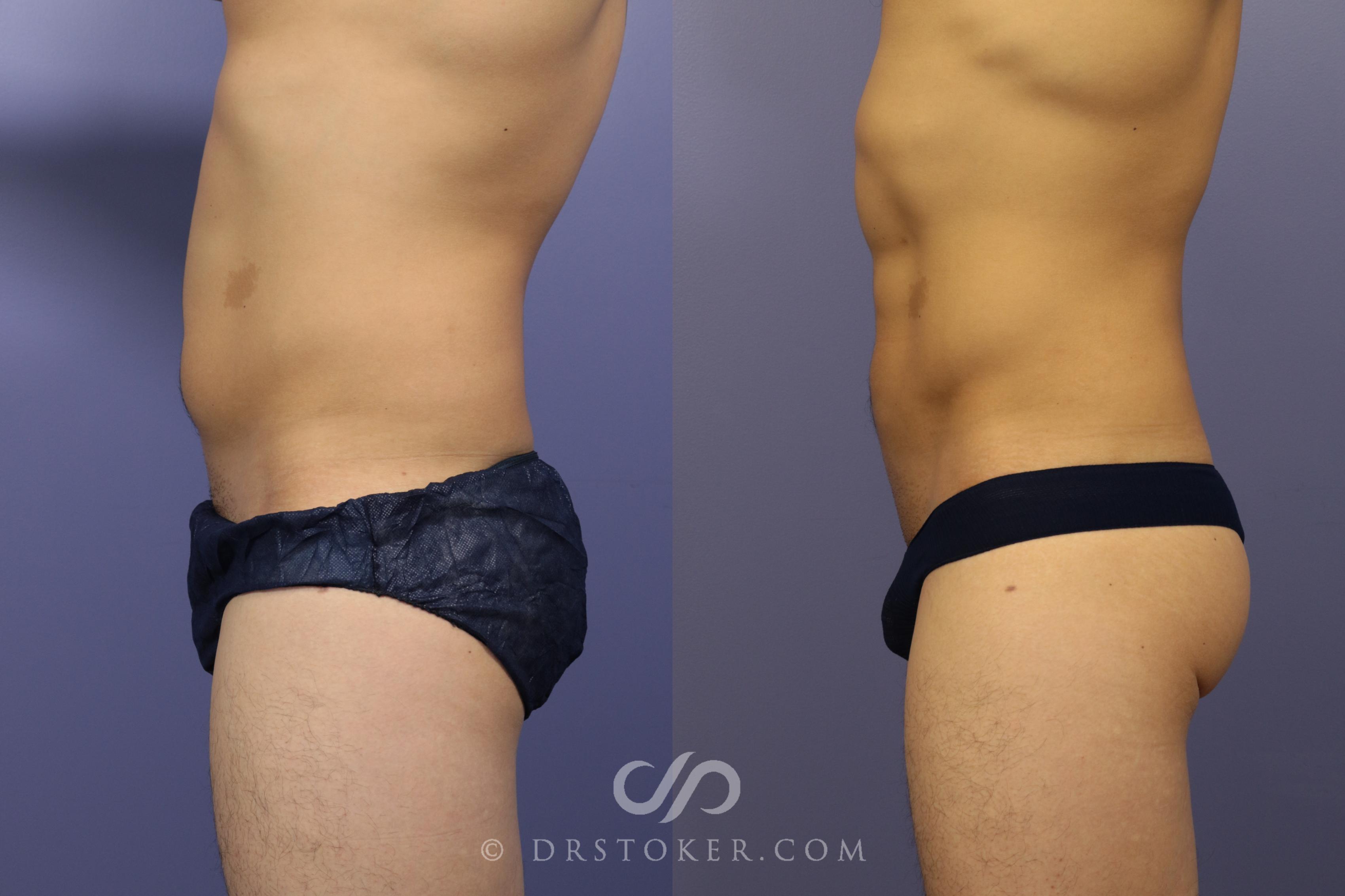 Before & After Liposuction - Abdominal Etching & Sculpting Case 986 View #2 View in Los Angeles, CA
