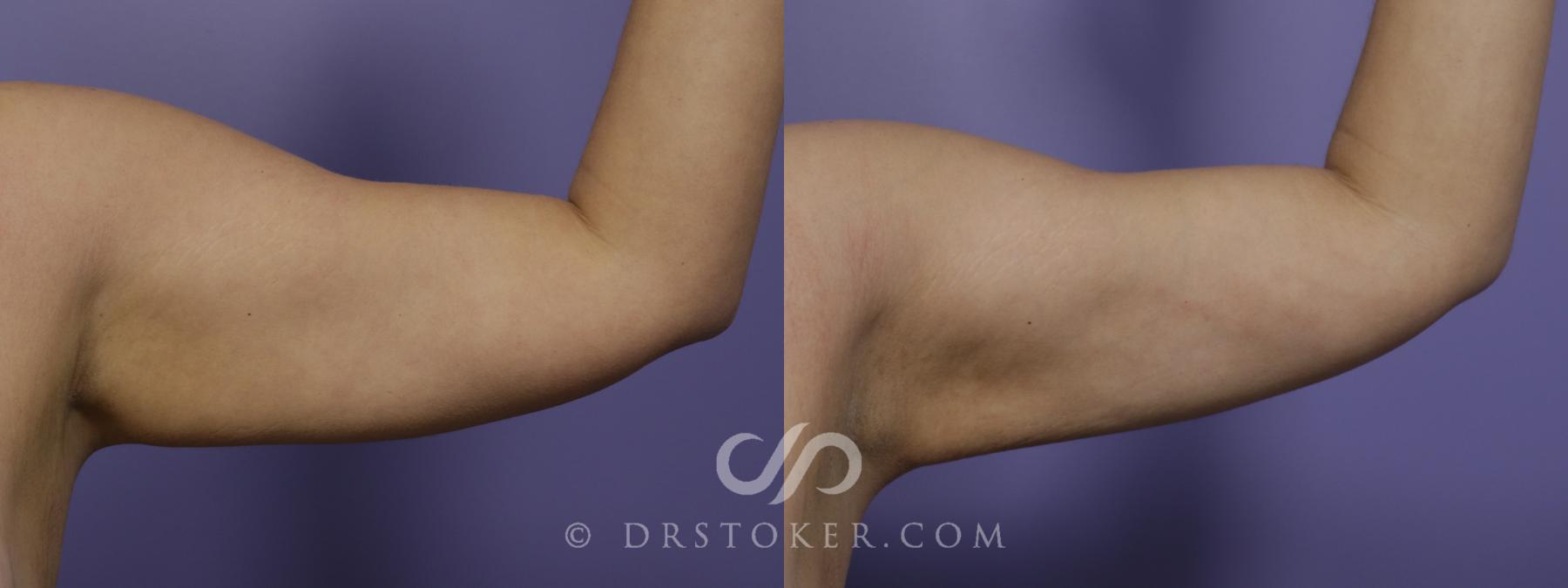 Before & After Liposuction - Axillary Fat Removal Case 1456 View #1 View in Los Angeles, CA
