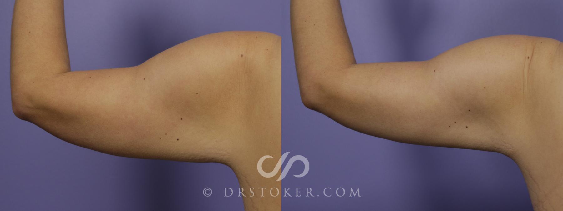 Before & After Liposuction - Axillary Fat Removal Case 1457 View #1 View in Los Angeles, CA