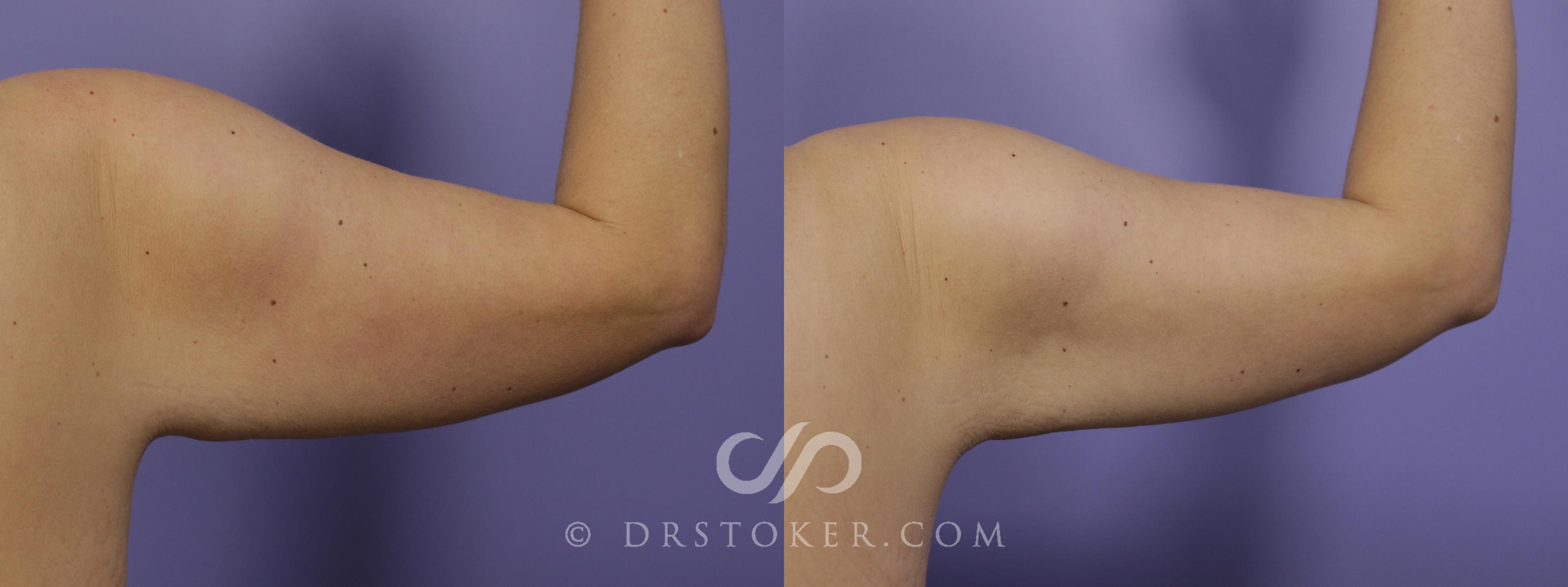 Before & After Liposuction - Axillary Fat Removal Case 1458 View #1 View in Marina del Rey, CA