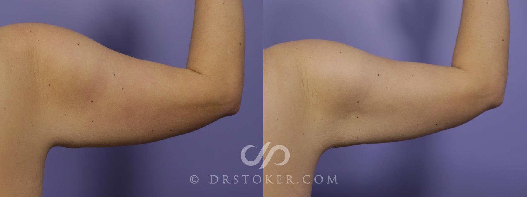 Before & After Liposuction - Axillary Fat Removal Case 1458 View #1 View in Los Angeles, CA