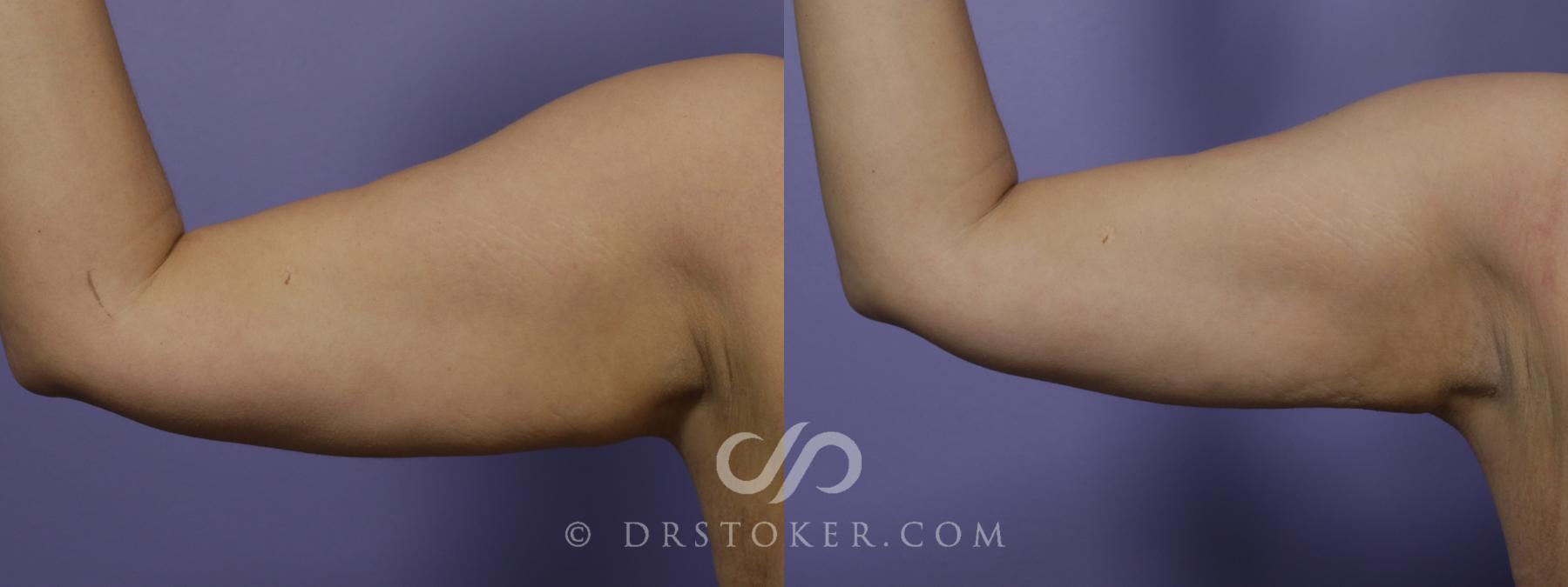 Before & After Liposuction - Axillary Fat Removal Case 1459 View #1 View in Los Angeles, CA