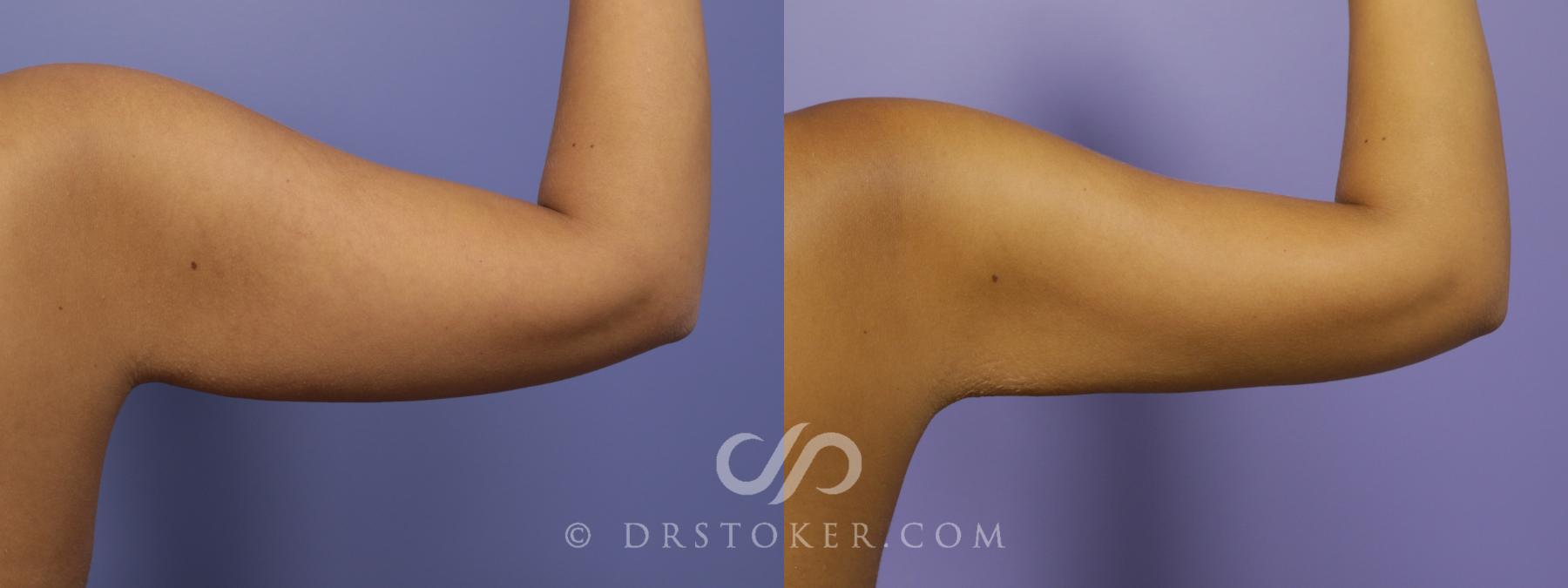 Before & After Liposuction - Axillary Fat Removal Case 1481 View #2 View in Los Angeles, CA