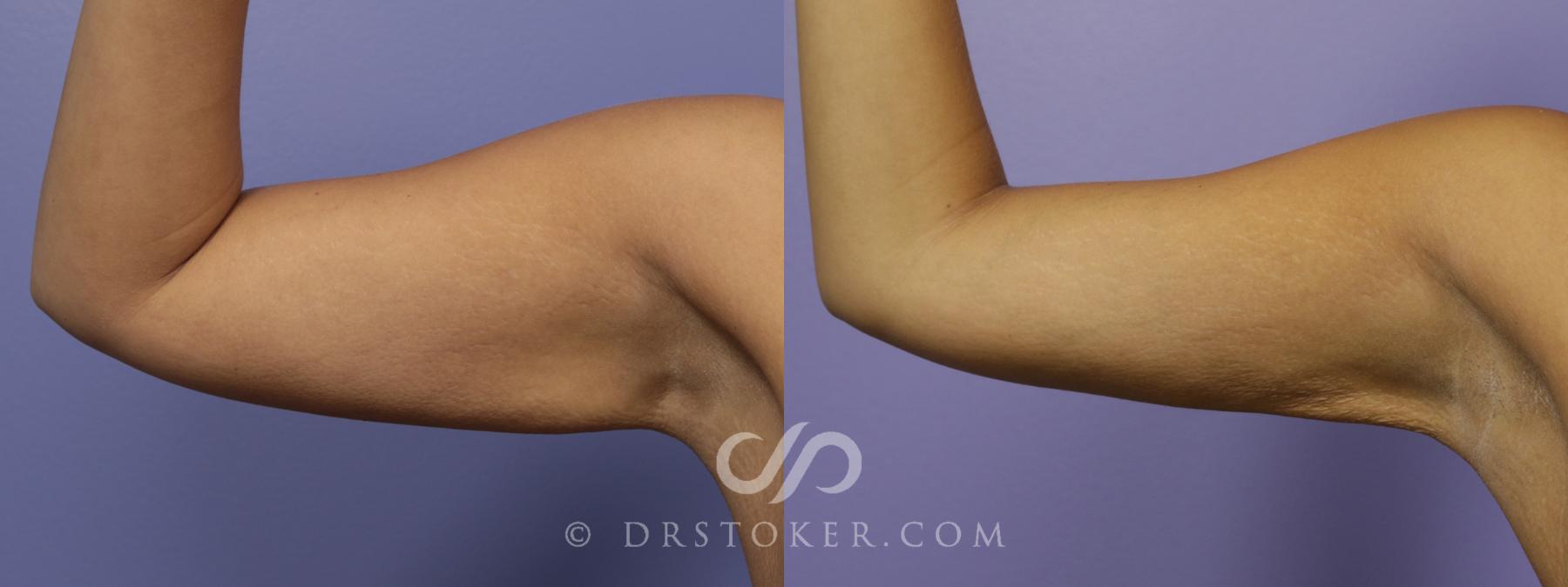 Before & After Liposuction - Axillary Fat Removal Case 1482 View #1 View in Los Angeles, CA