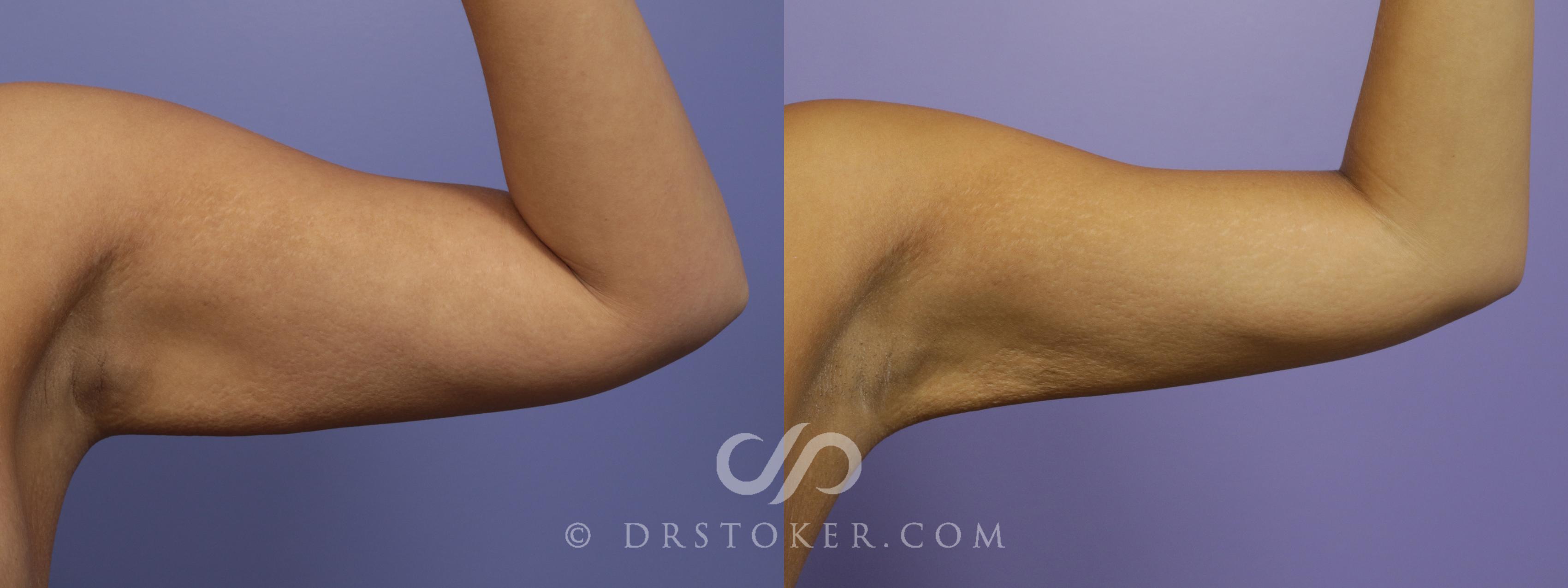 Before & After Liposuction - Axillary Fat Removal Case 1483 View #1 View in Marina del Rey, CA