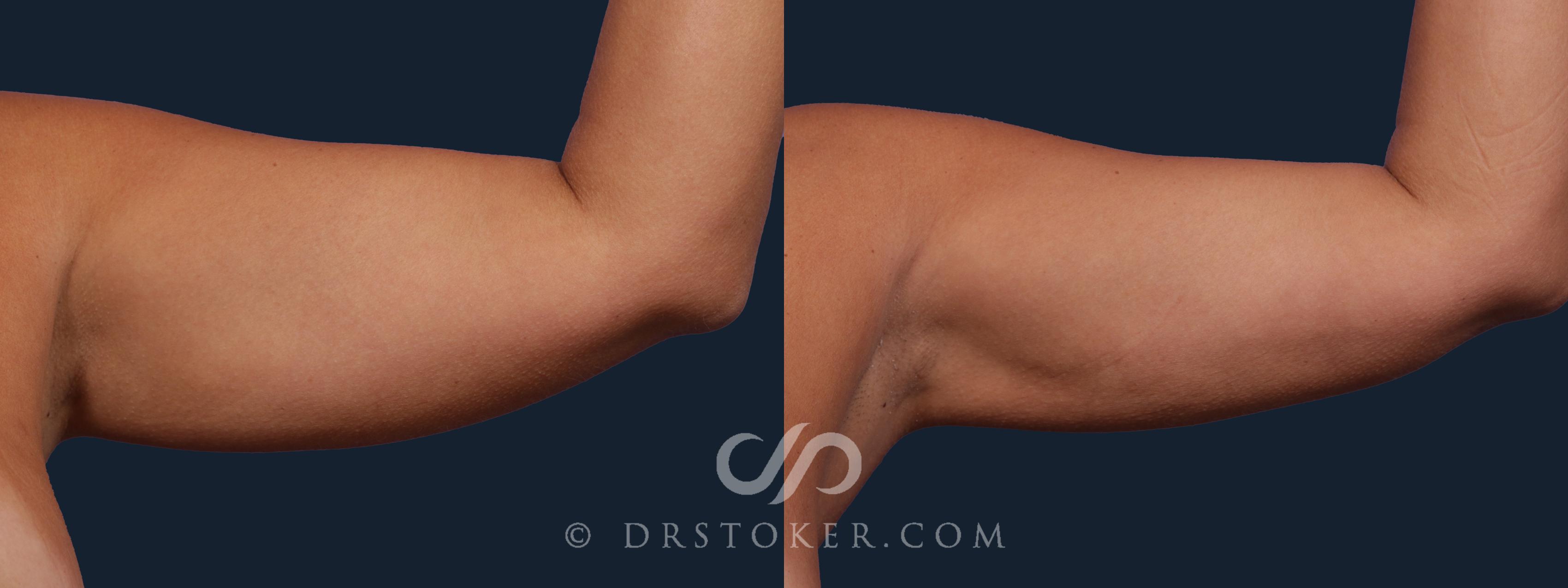 Before & After Liposuction - Axillary Fat Removal Case 2026 Left Side View in Los Angeles, CA