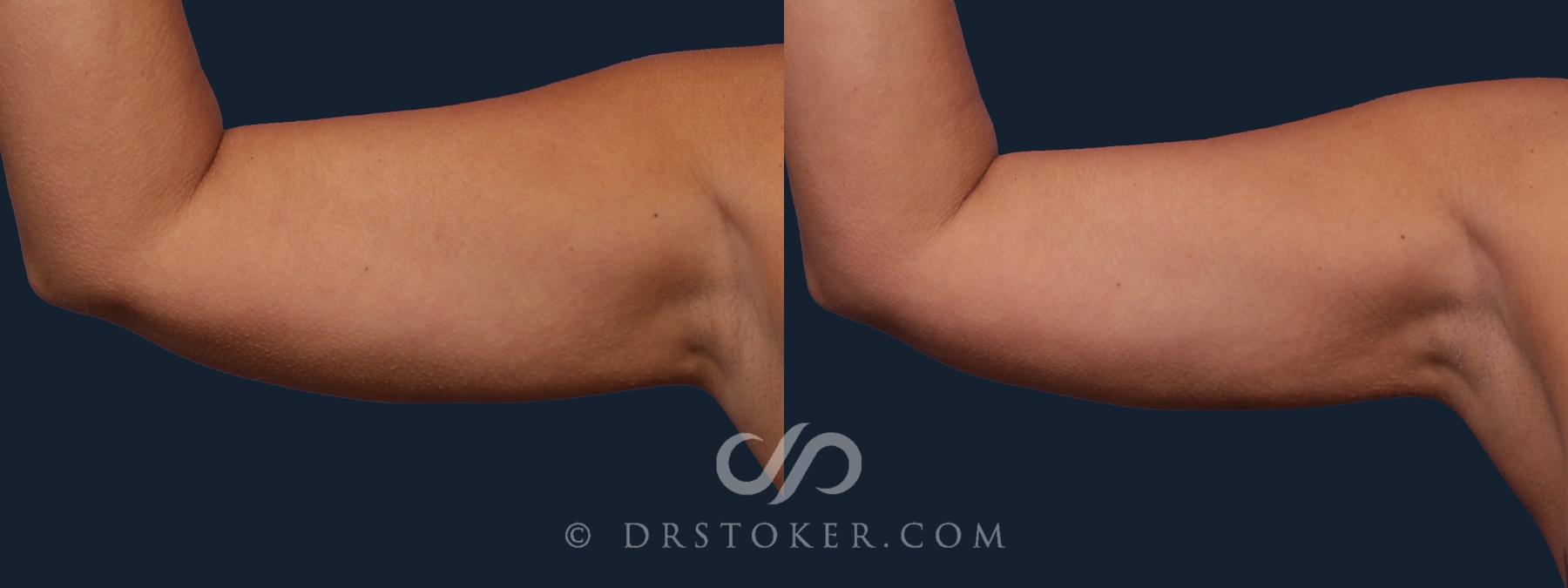 Before & After Liposuction - Axillary Fat Removal Case 2026 Right Side View in Los Angeles, CA
