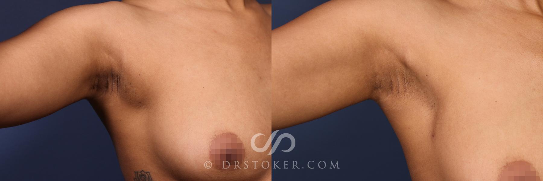 Before & After Liposuction - Axillary Fat Removal Case 2641 Left Oblique View in Los Angeles, CA