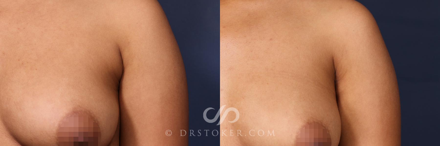 Before & After Liposuction - Axillary Fat Removal Case 2641 Left Side View in Los Angeles, CA