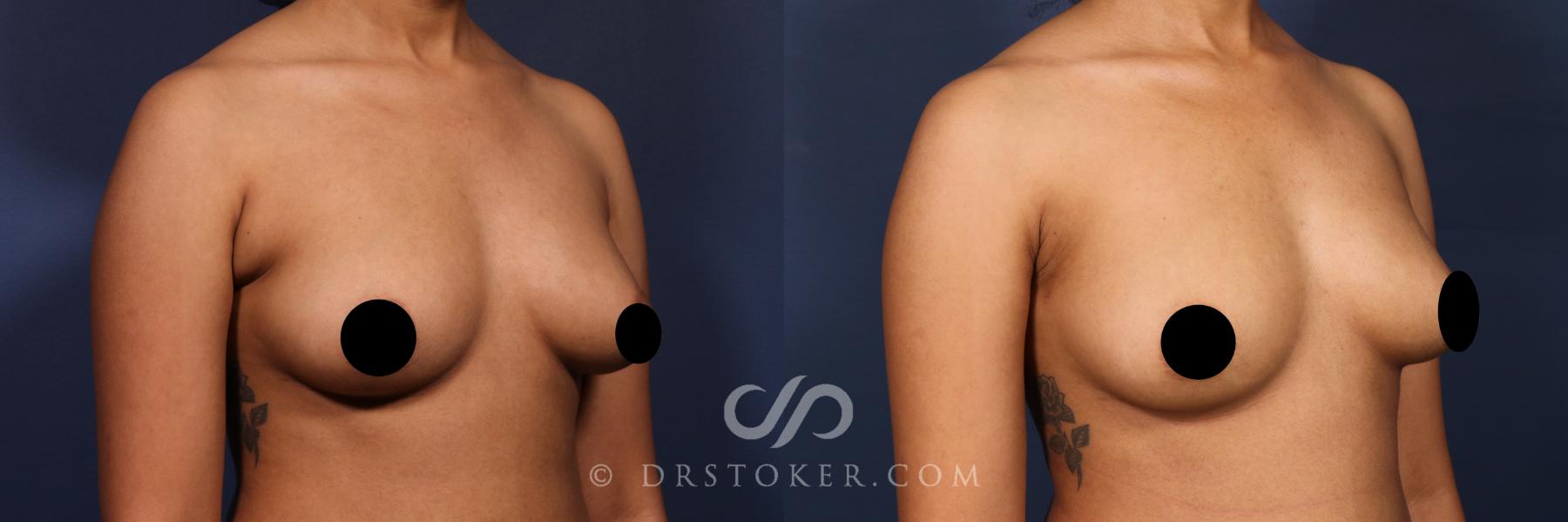 Before & After Liposuction - Axillary Fat Removal Case 2641 Right Oblique View in Los Angeles, CA