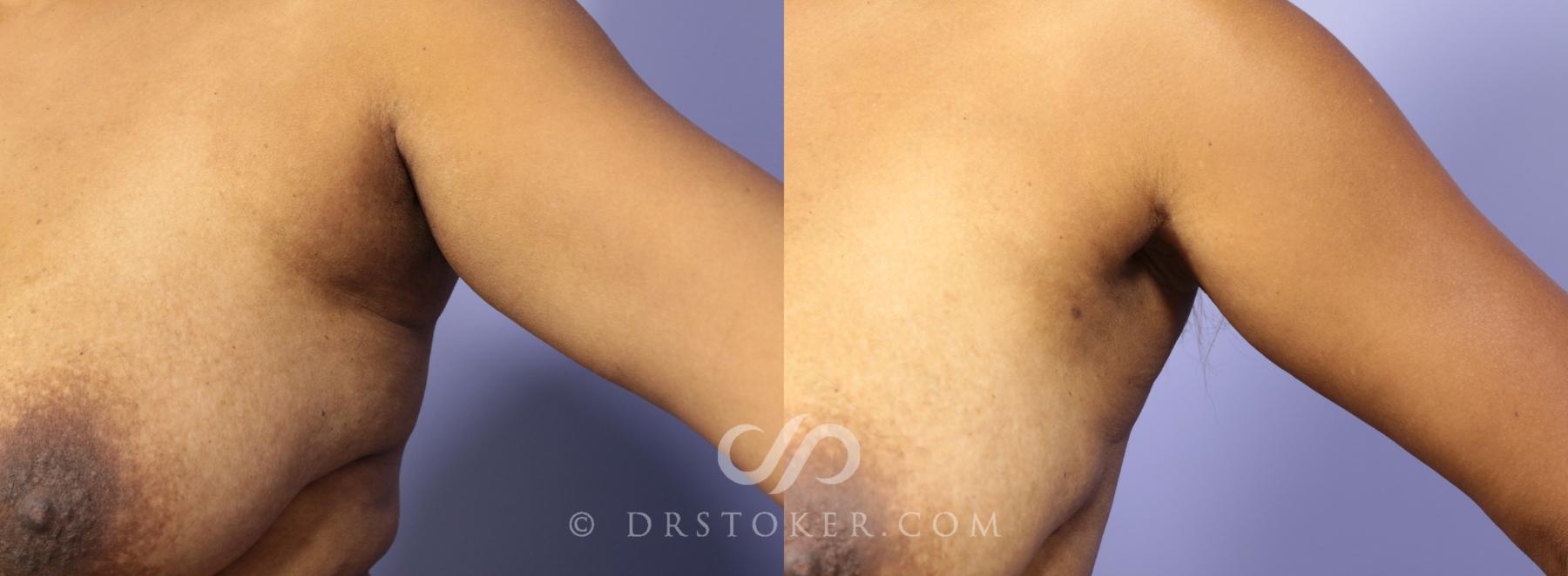 Before & After Liposuction - Axillary Fat Removal Case 996 View #1 View in Los Angeles, CA