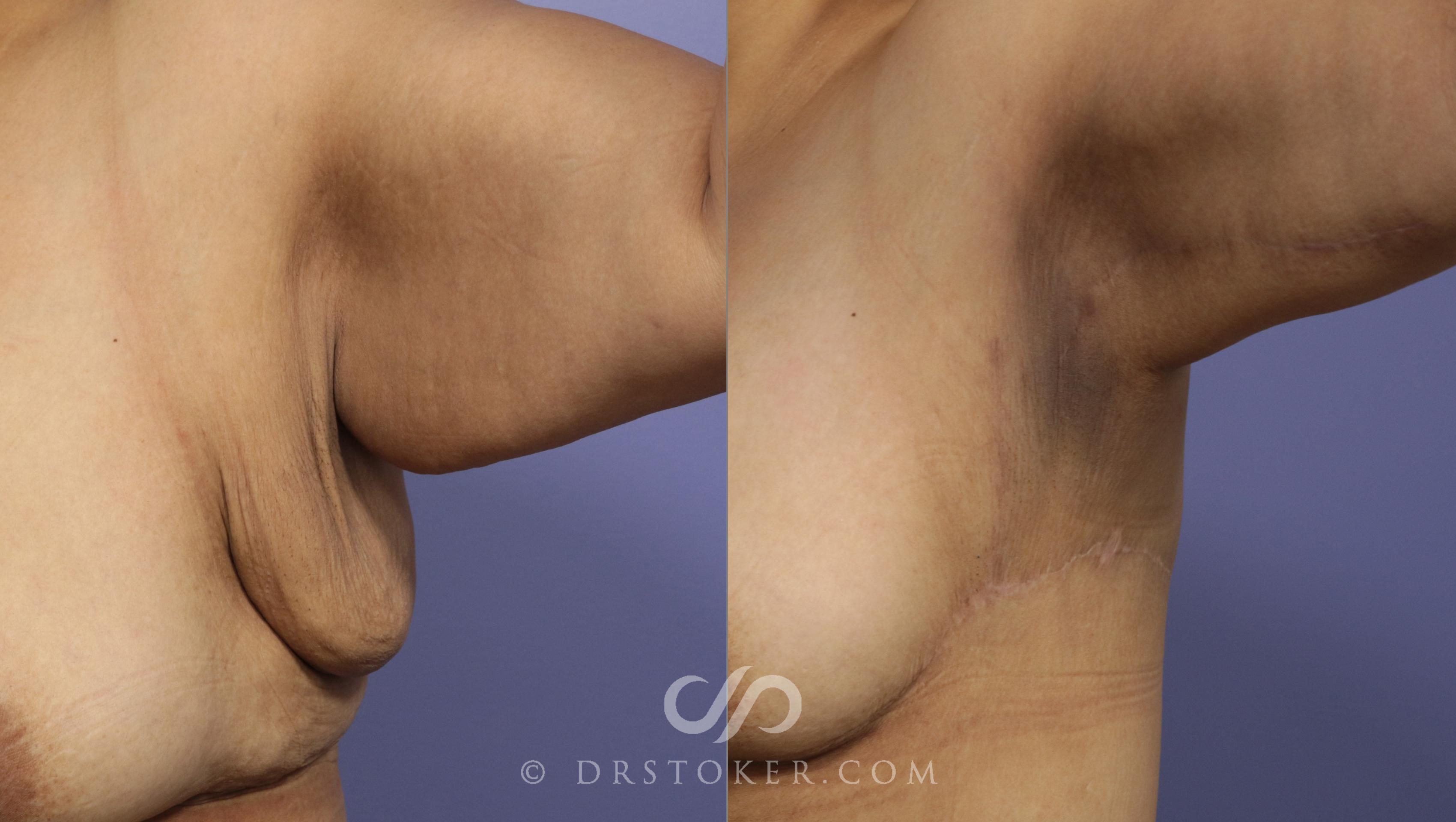 Before & After Liposuction - Axillary Fat Removal Case 997 View #1 View in Los Angeles, CA
