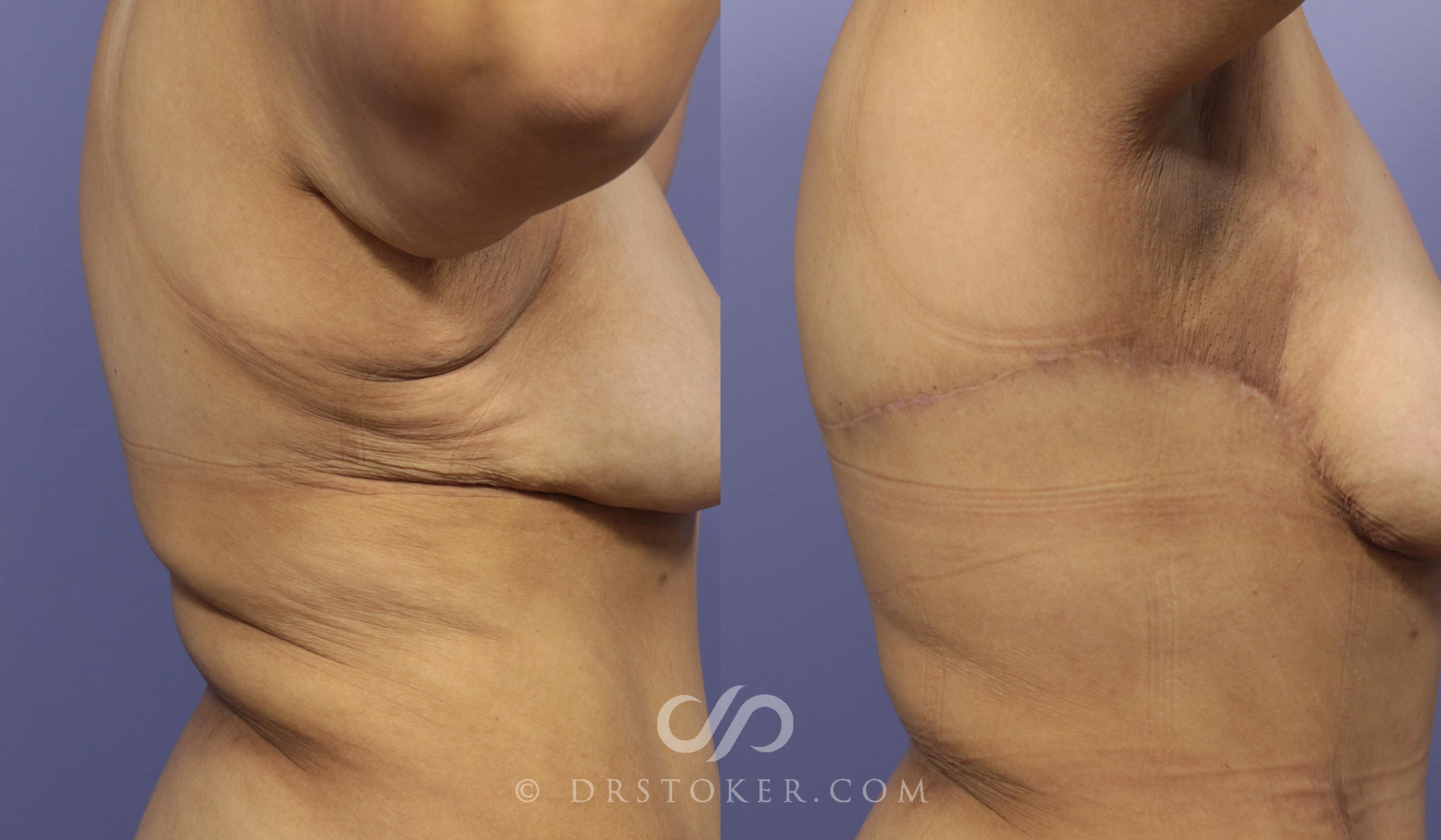 Before & After Liposuction - Axillary Fat Removal Case 999 View #1 View in Marina del Rey, CA
